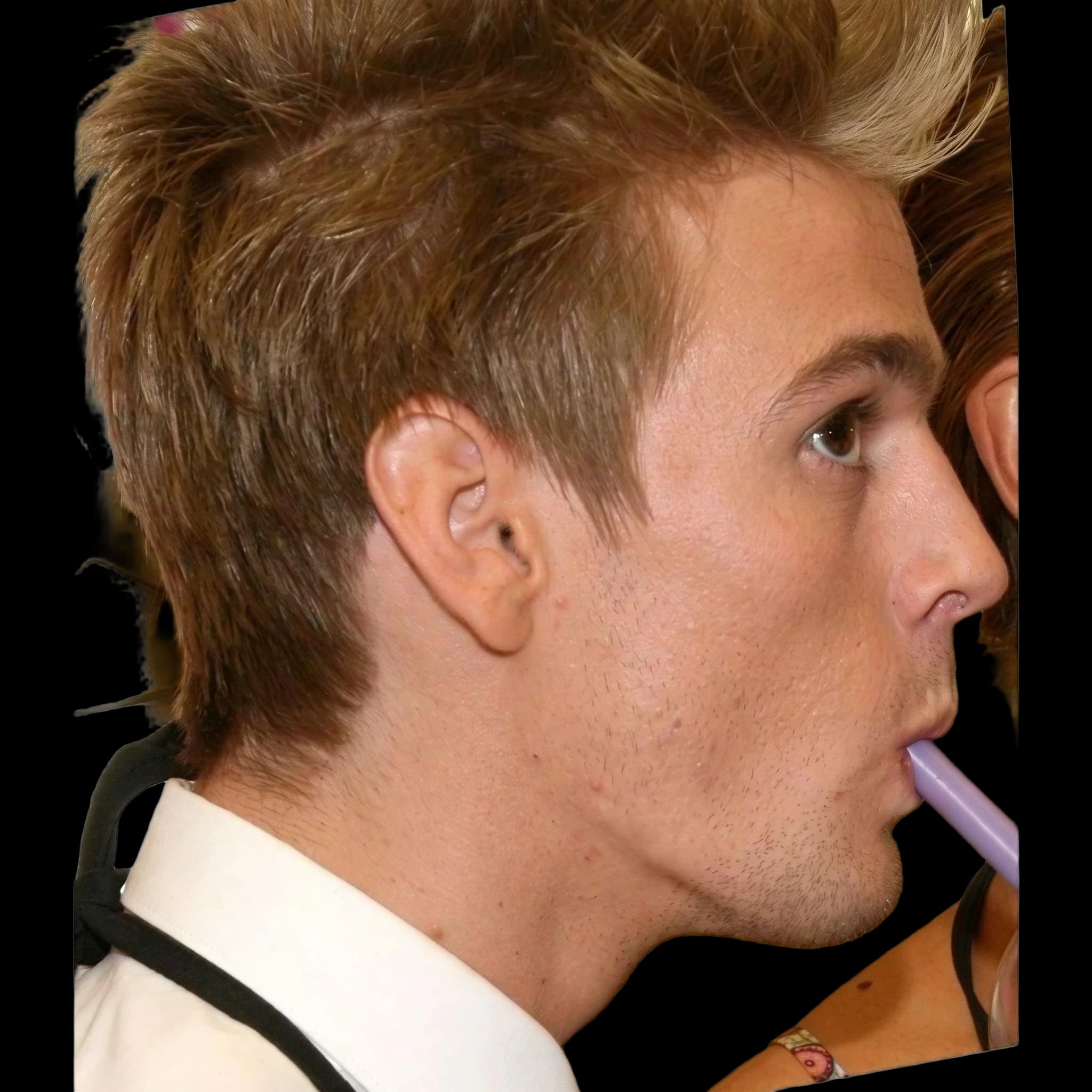 Aaron Carter, Eye Protrusion