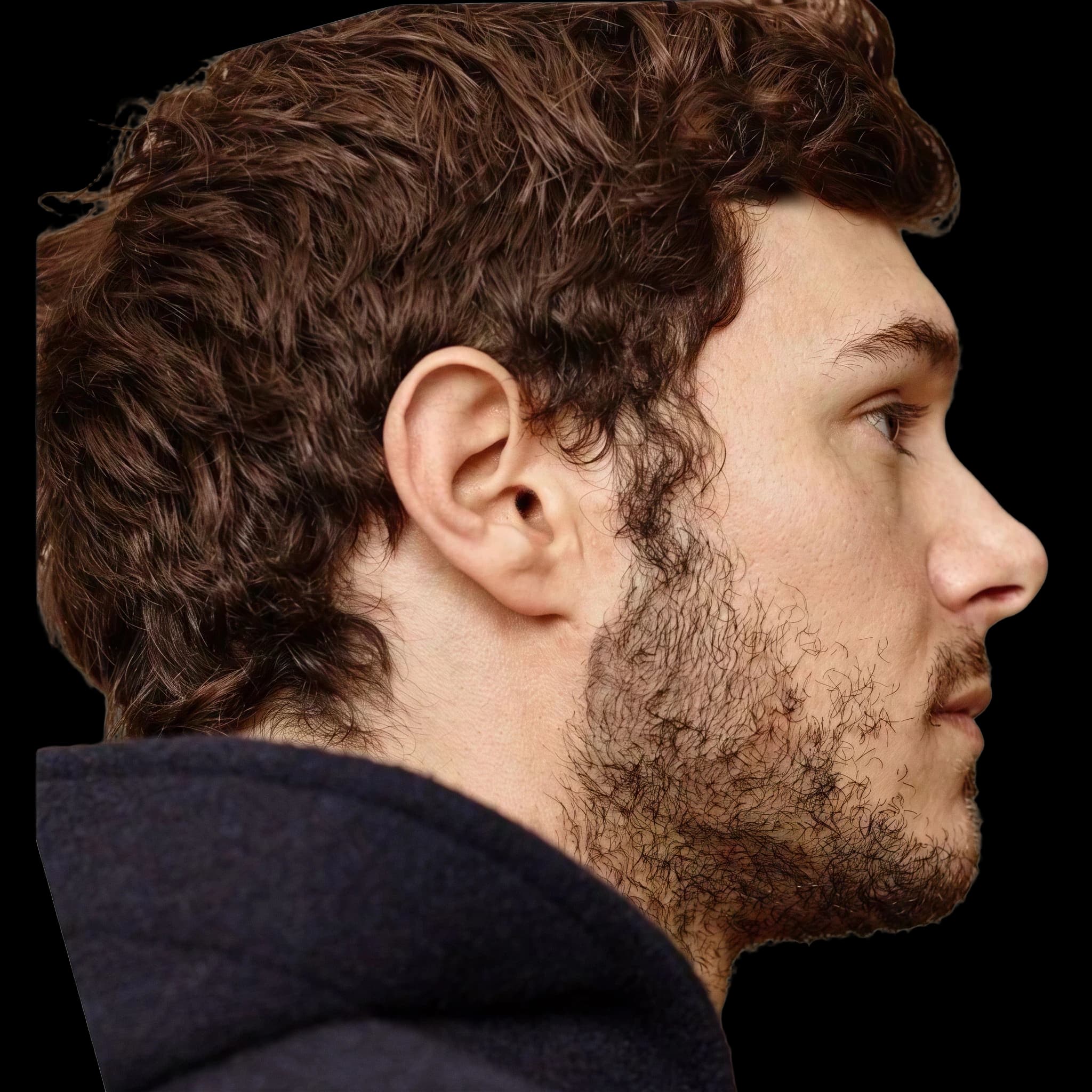 Adam Brody, Mandibular Plane Angle