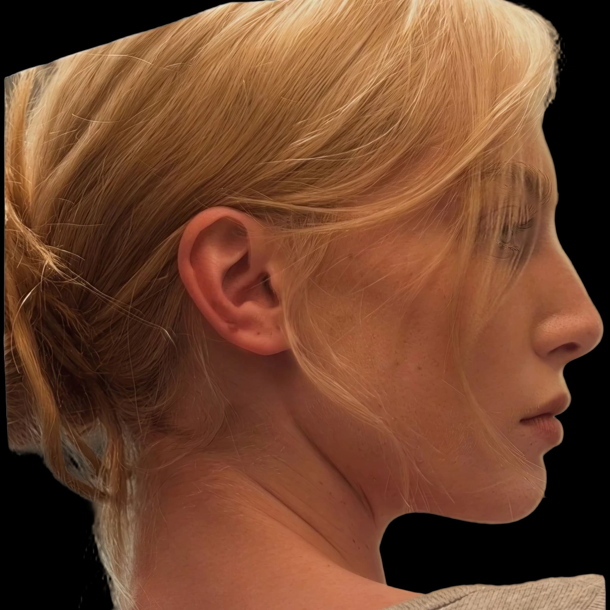 Alex Consani, Mentolabial Angle