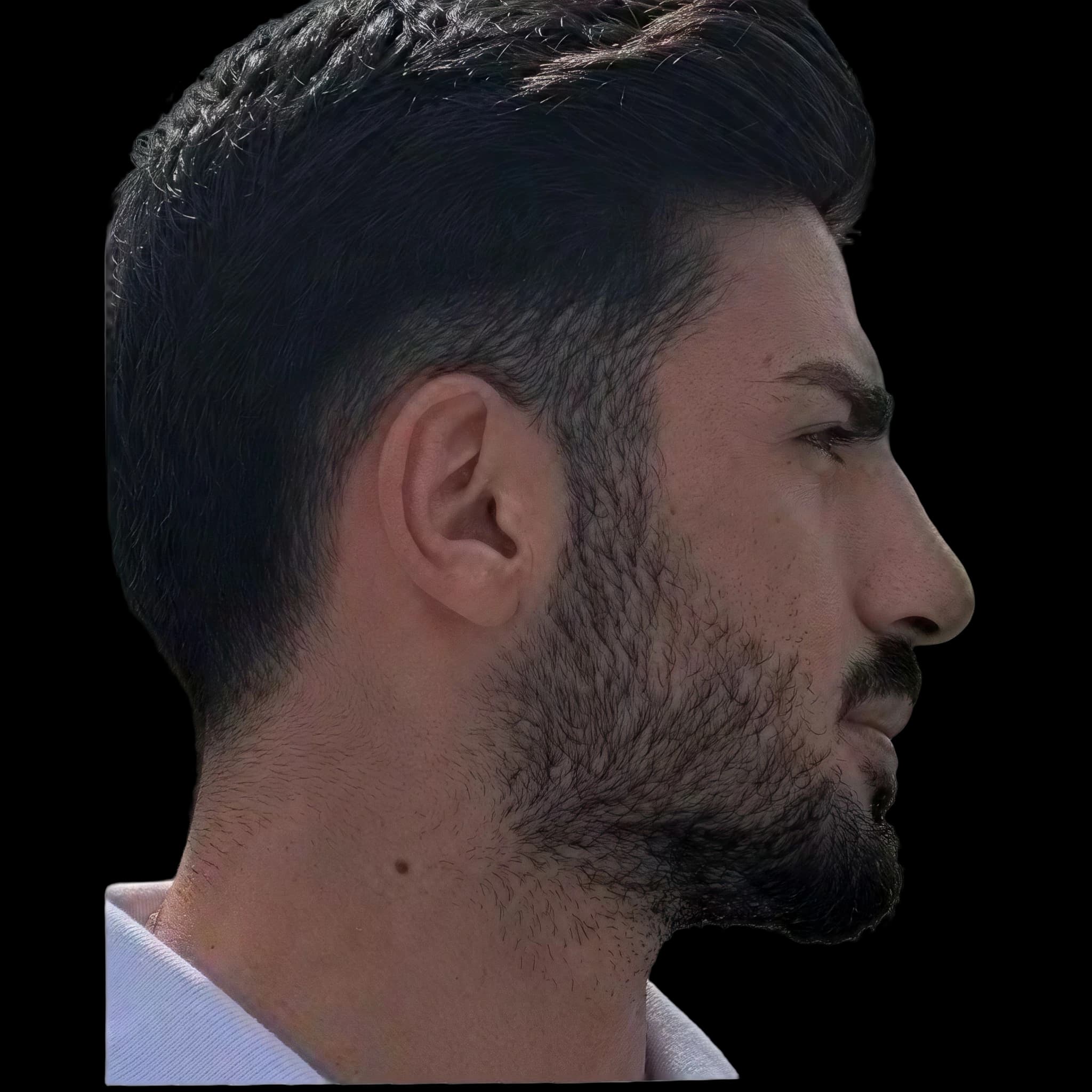 Alper Temel, Eye Protrusion