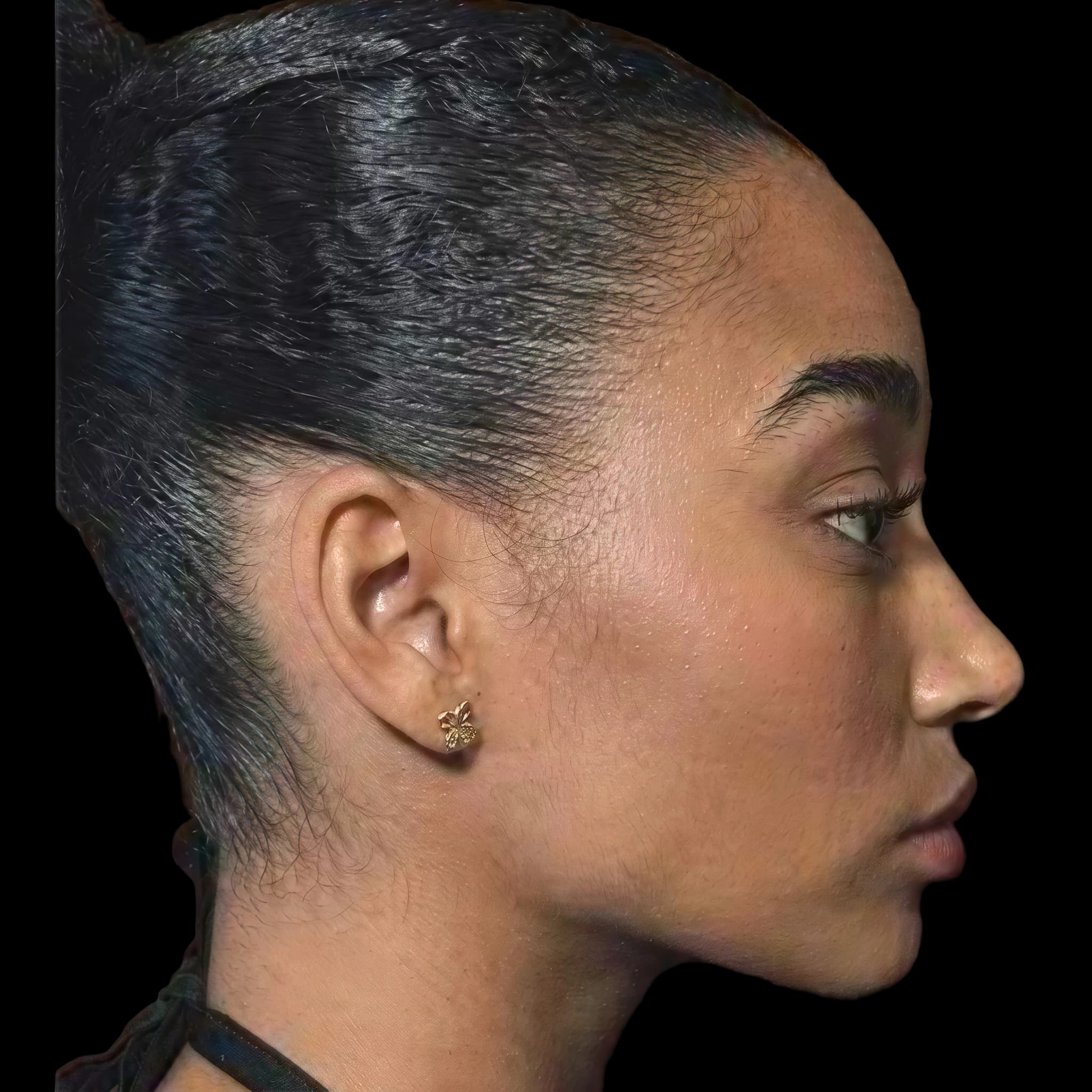 Amandla Stenberg, Eye Protrusion