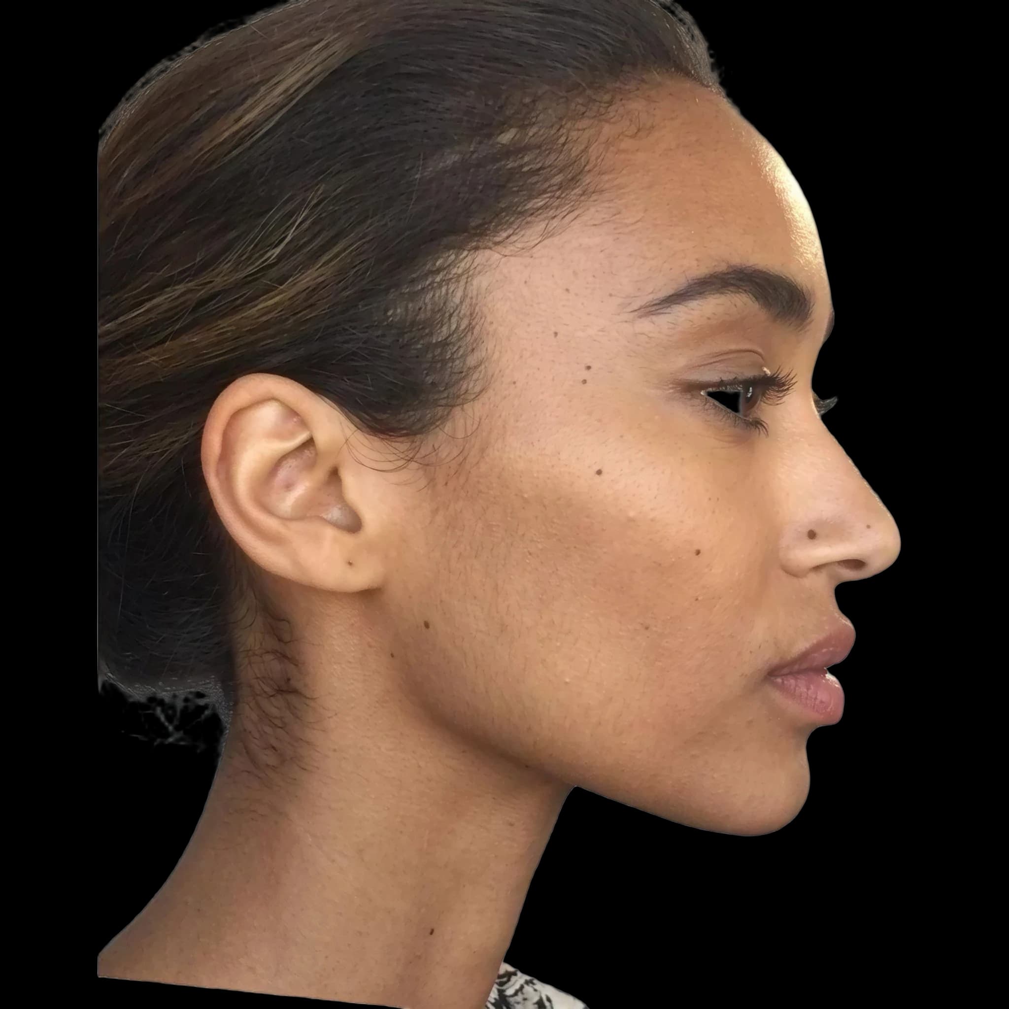 Anais Mali, Nasomental Angle