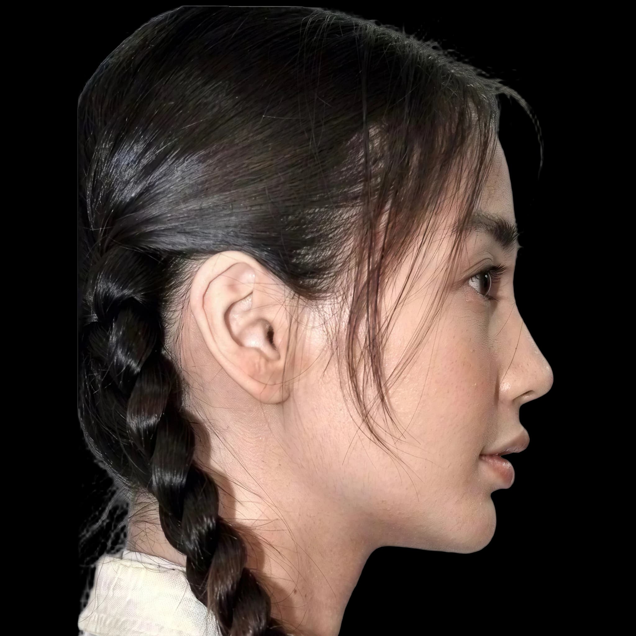 Angela Yeung Wing, Interior Midface Projection Angle