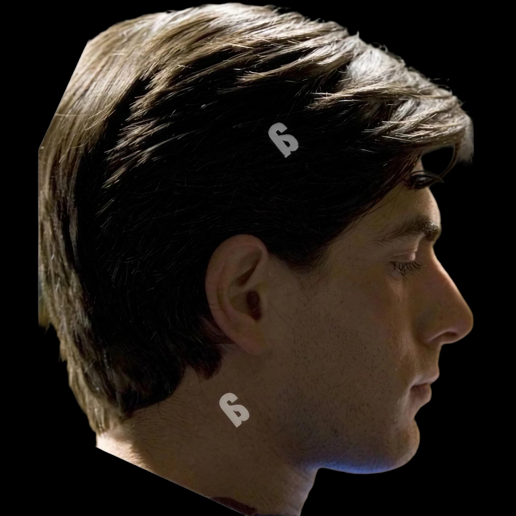 Brandon Routh, Upper Forehead Slope