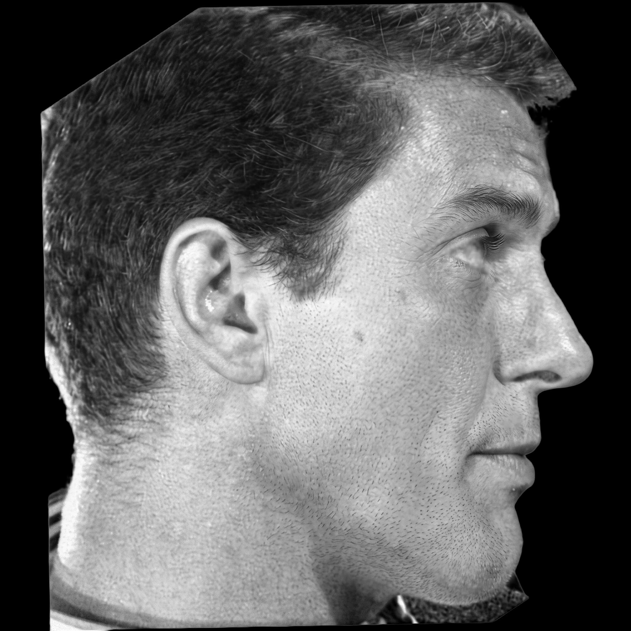 Dick Van Dyke, Upper Lip E-Line Position