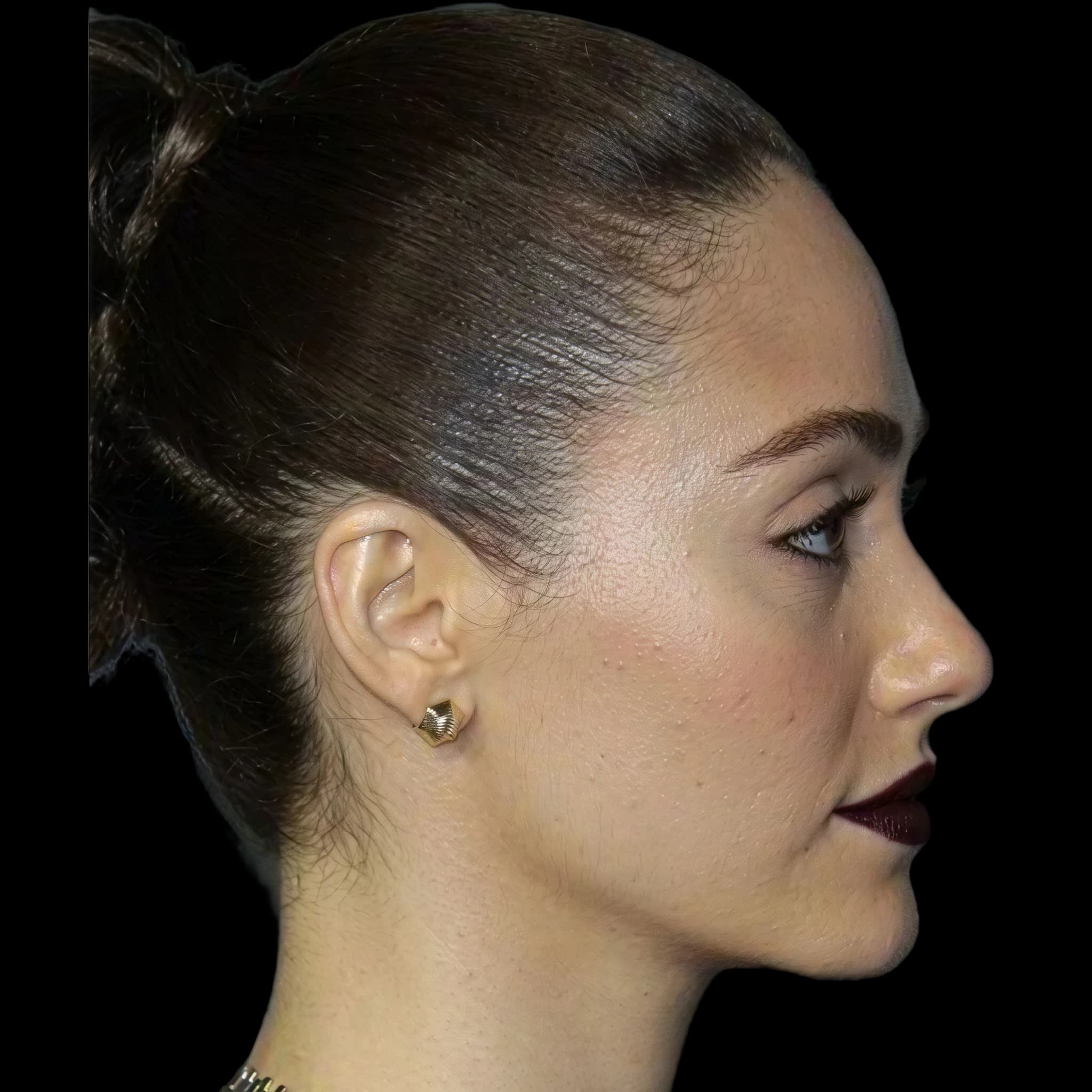 Emmy Rossum, Gonion to mouth line