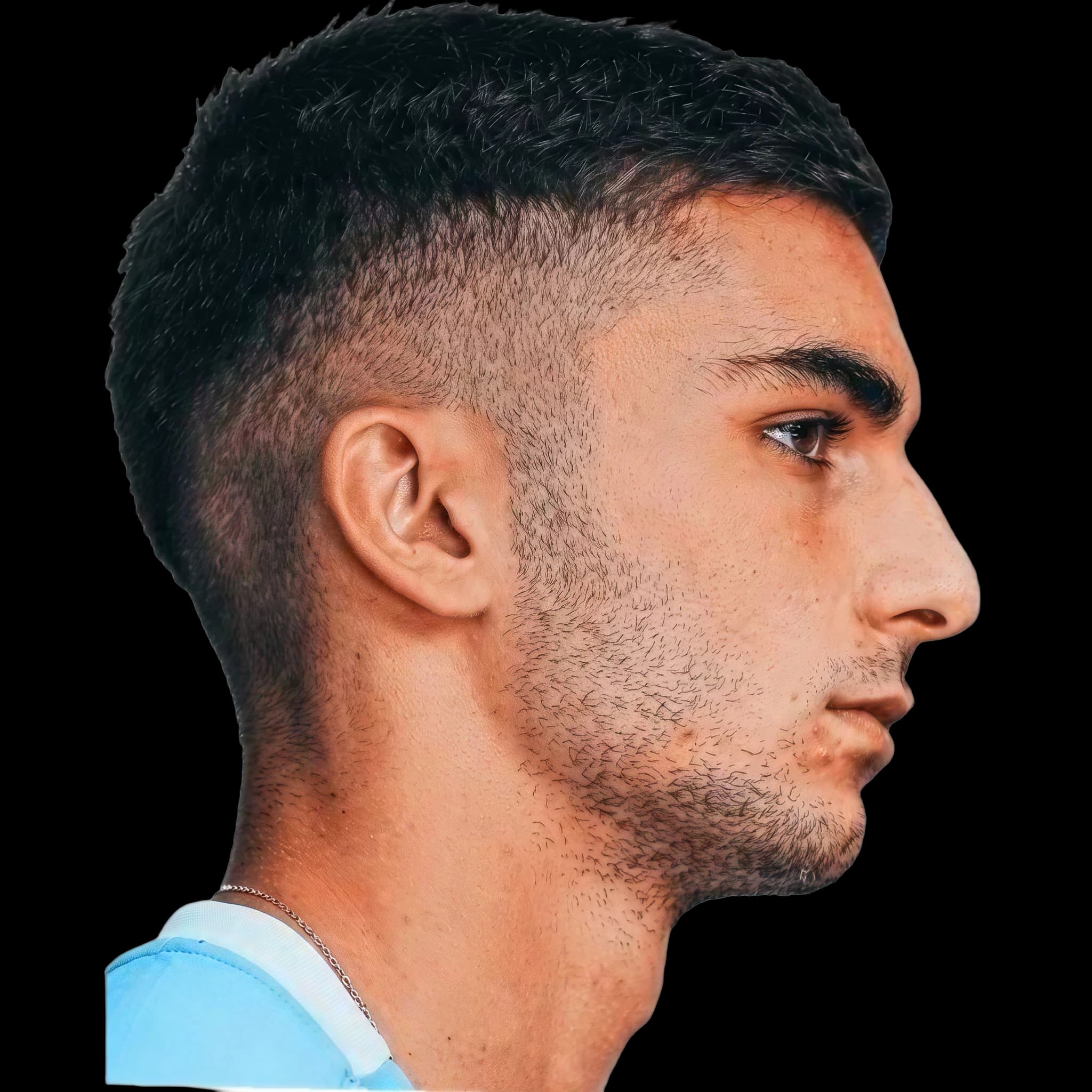 Ferran Torres, Eye Protrusion