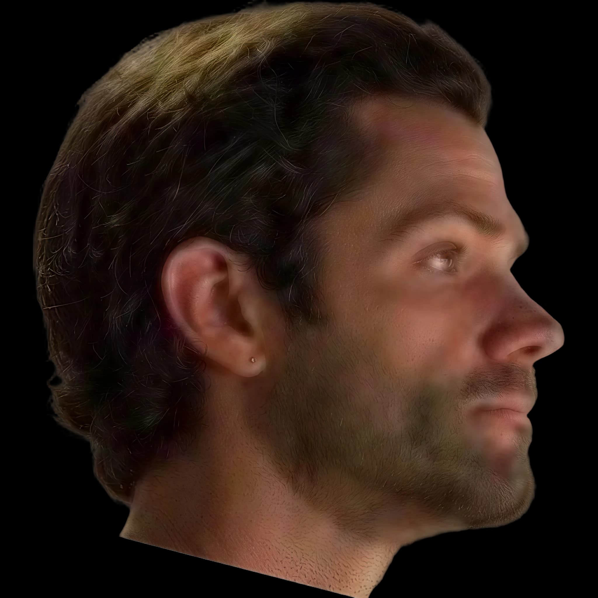 Jared Padalecki, Upper Lip Burstone Line