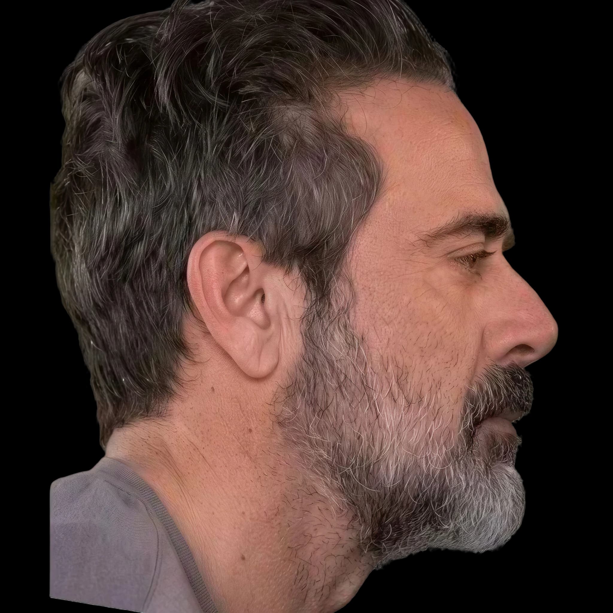 Jeffrey Dean Morgan, Interior Midface Projection Angle