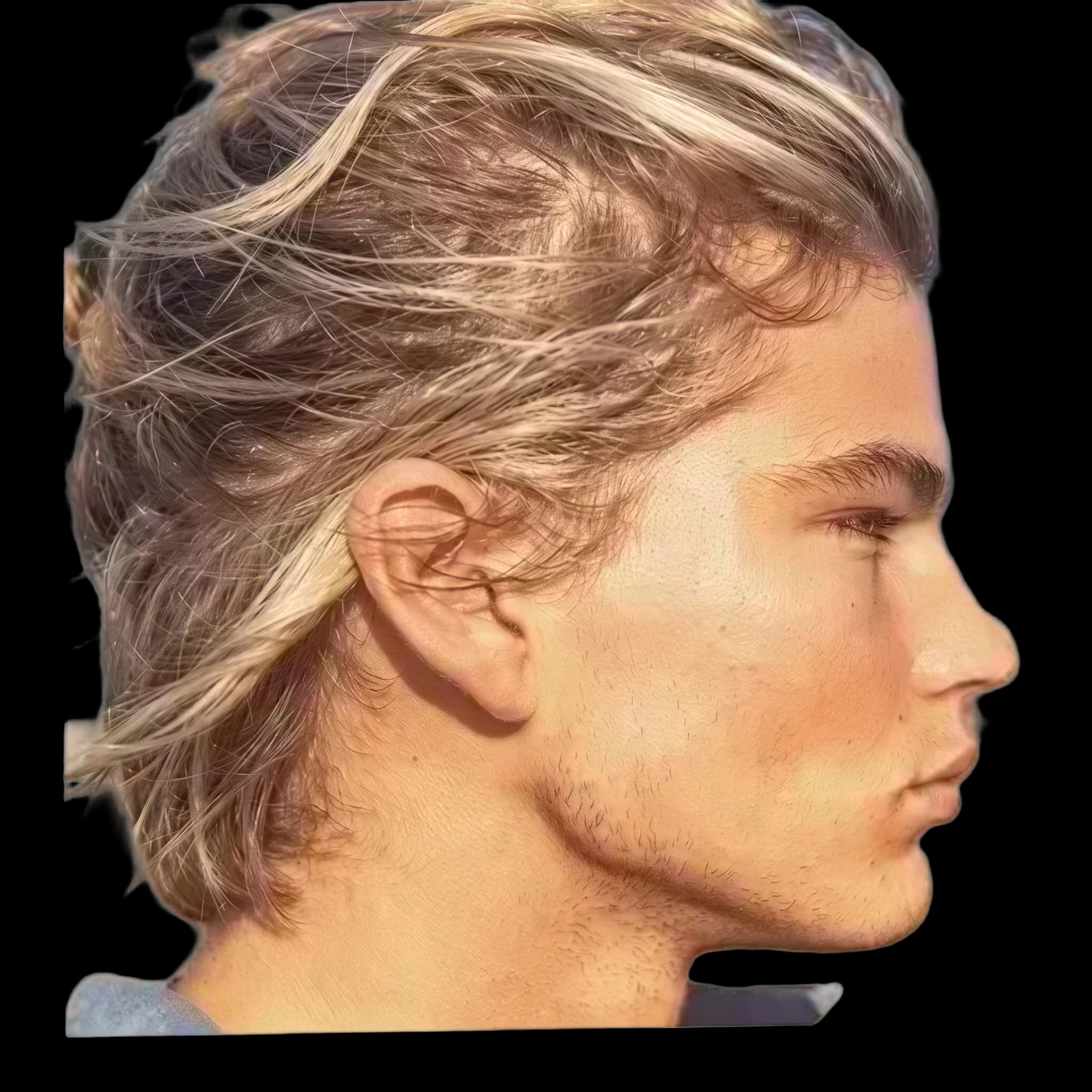 Jordan barrett (current), Eye Protrusion