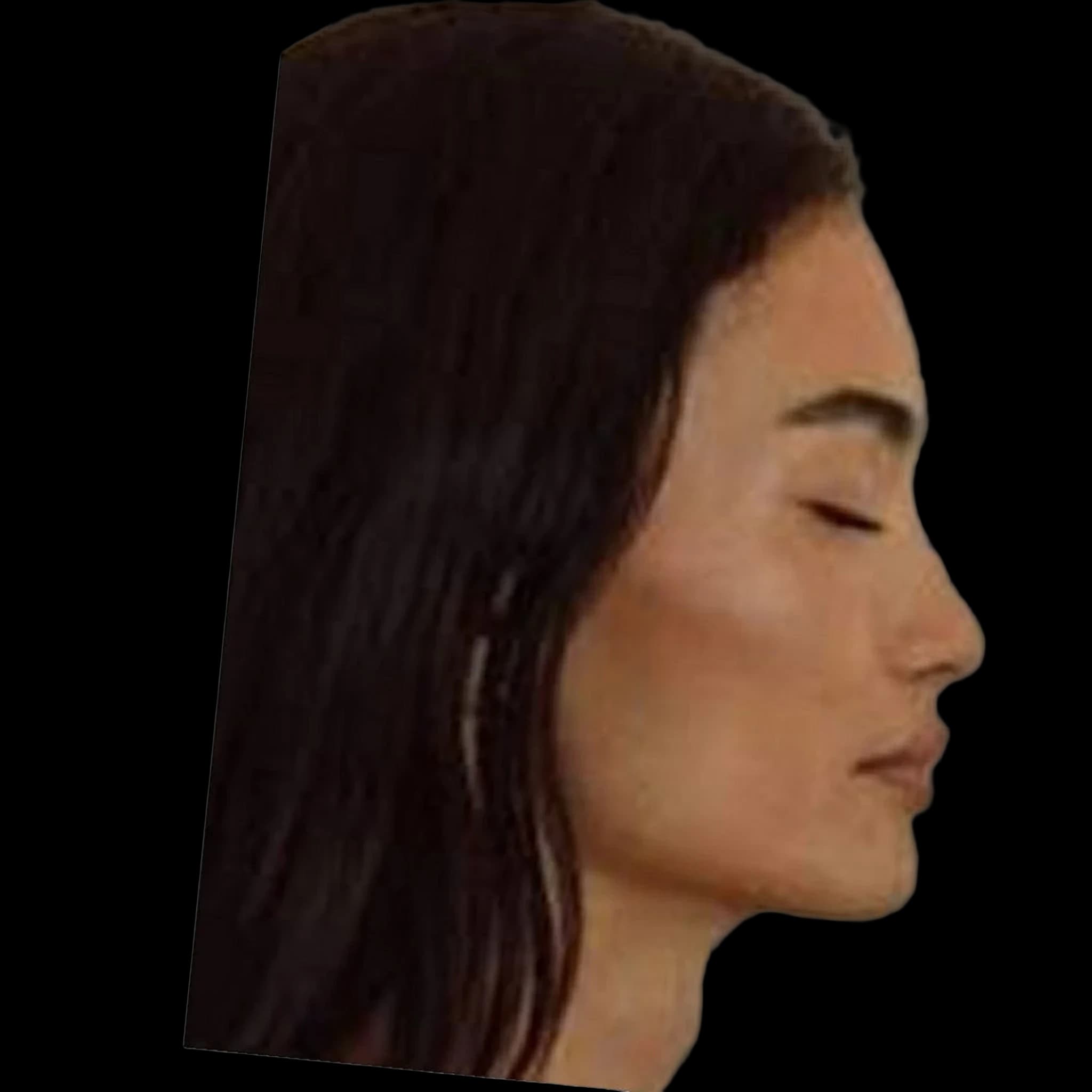 Kelly Gale, Nasal Tip Angle