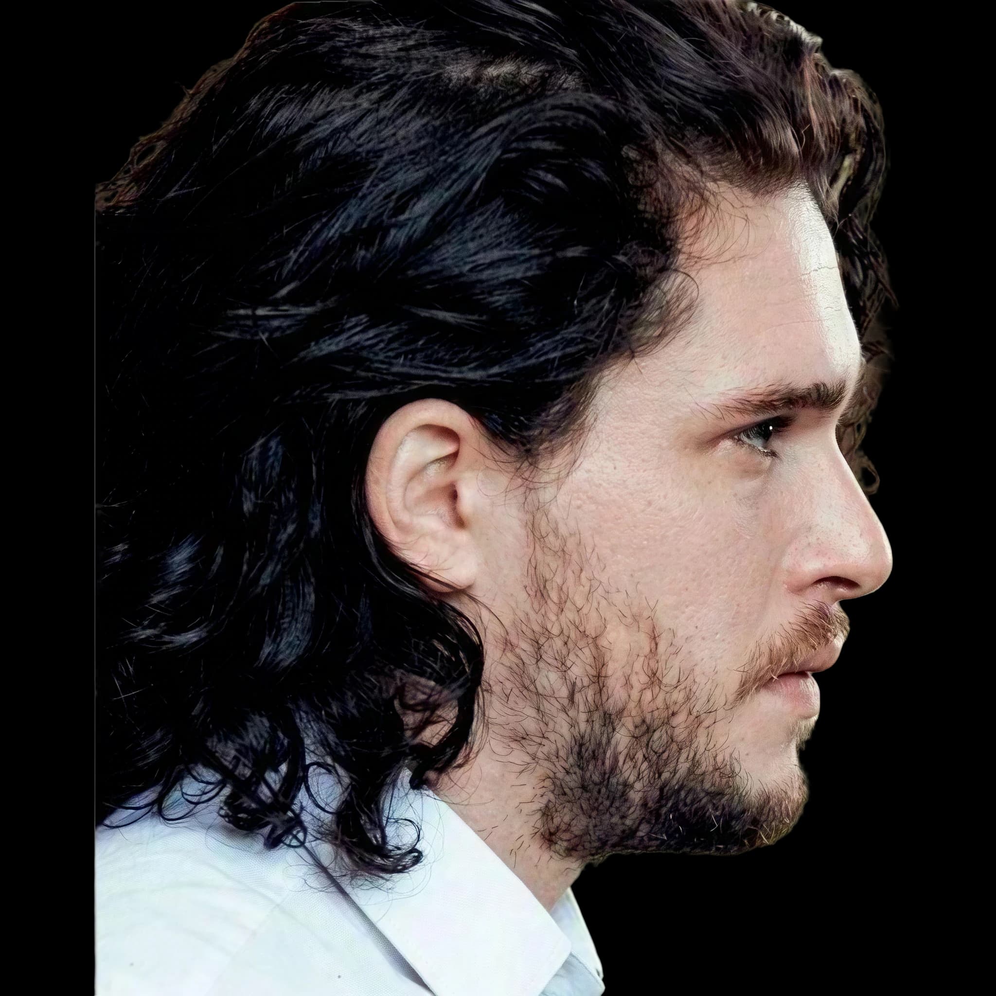 Kit Harrington, Eye Protrusion