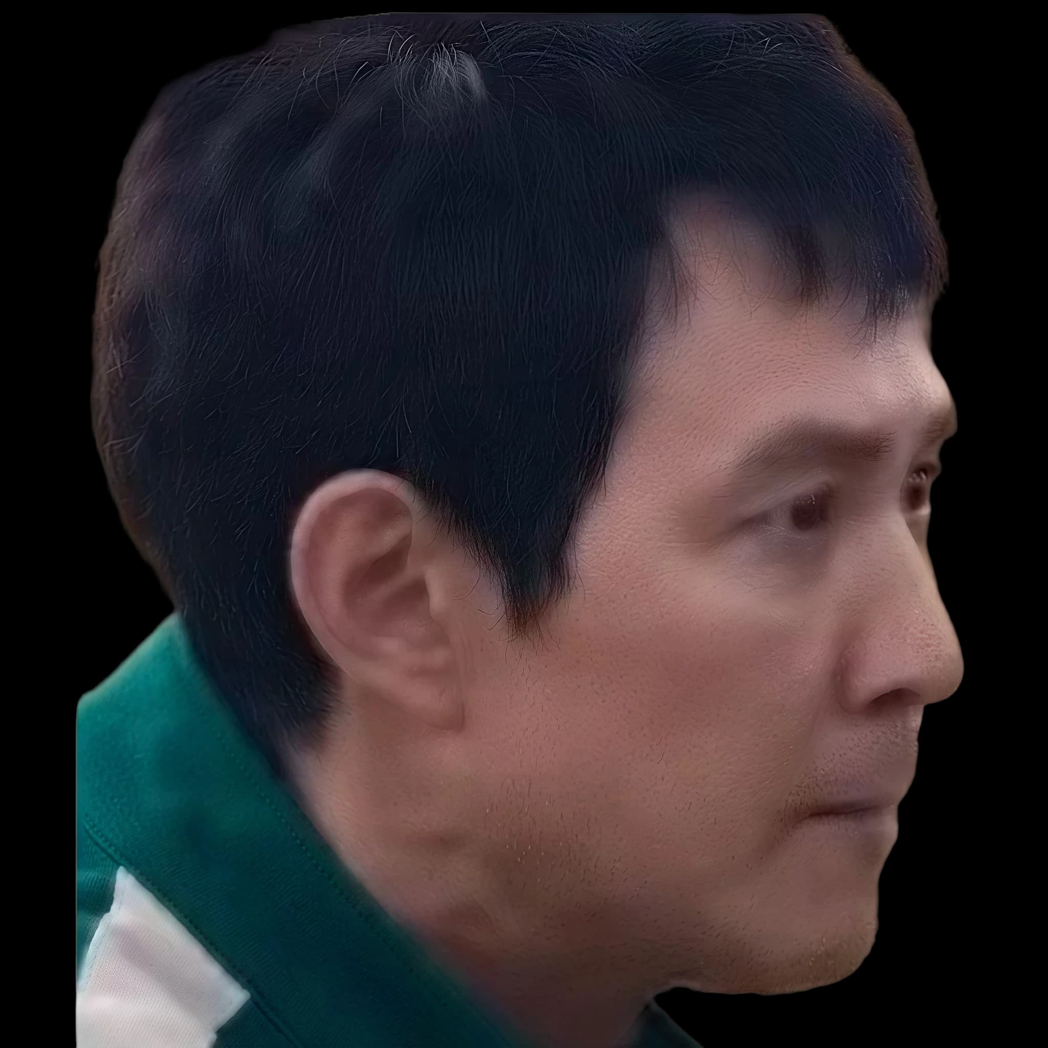 Lee Jung-jae, Submental Definition