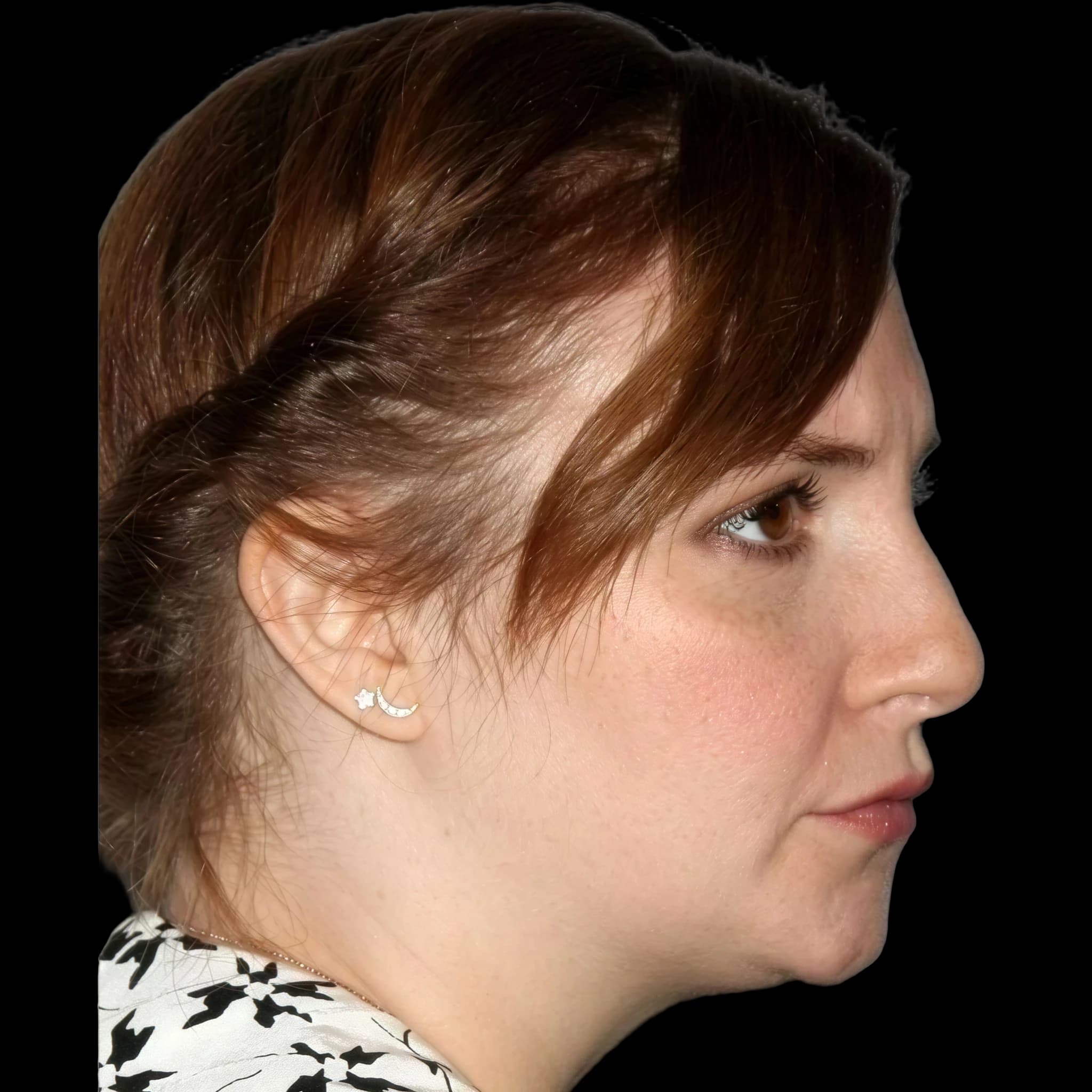 Lena Dunham, Mandibular Plane Angle