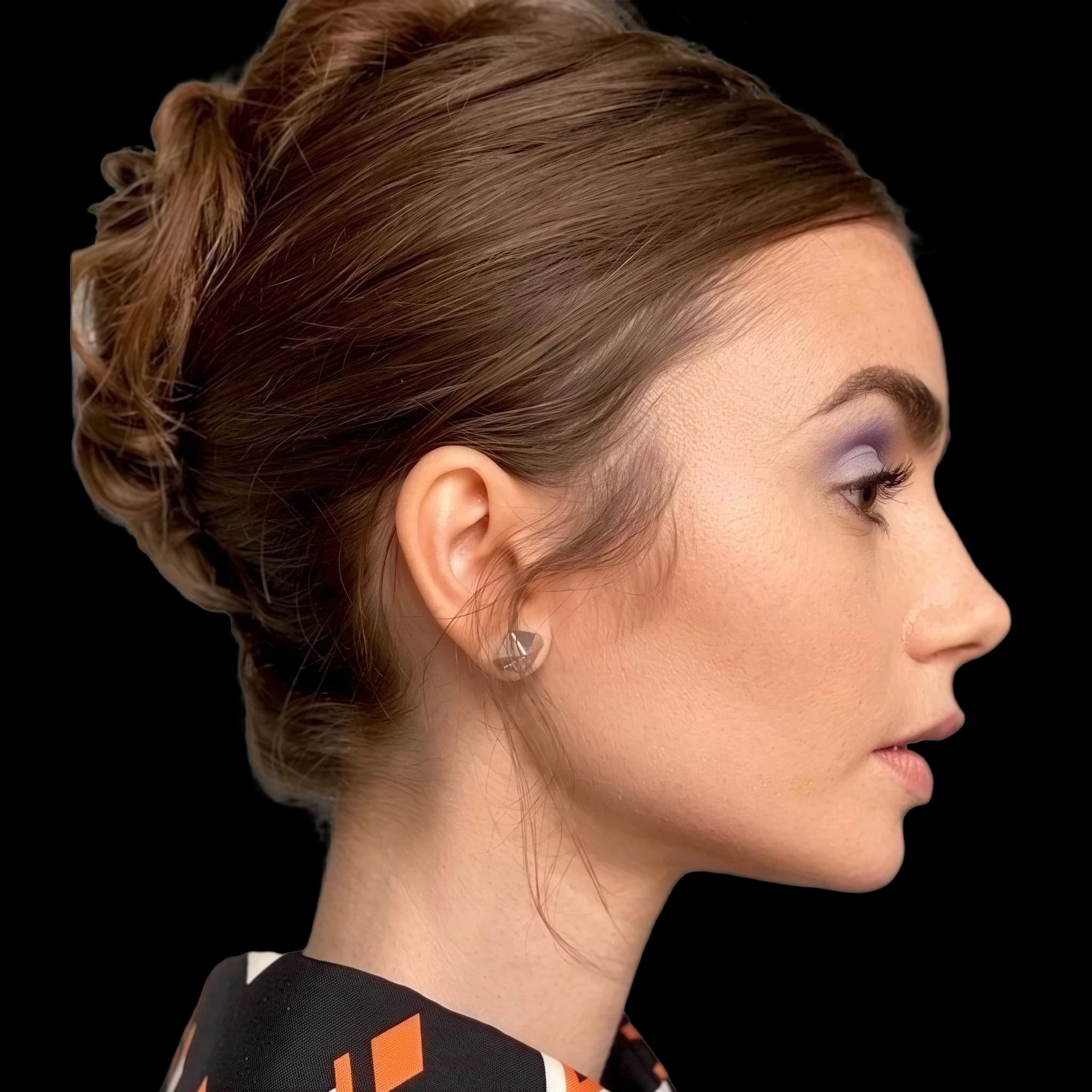 Lily Collins, Eye Protrusion