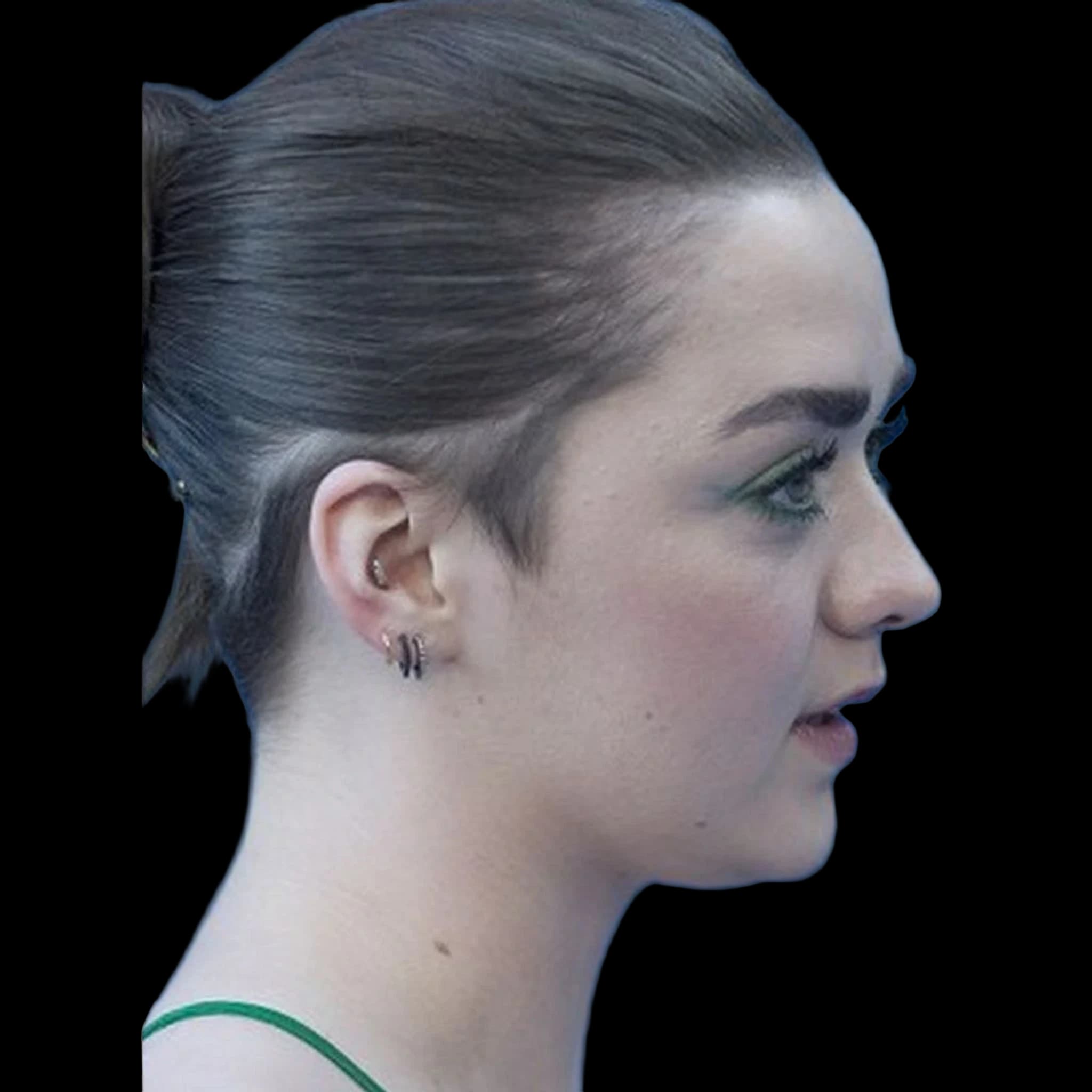 Maisie Williams, Nasofacial Angle