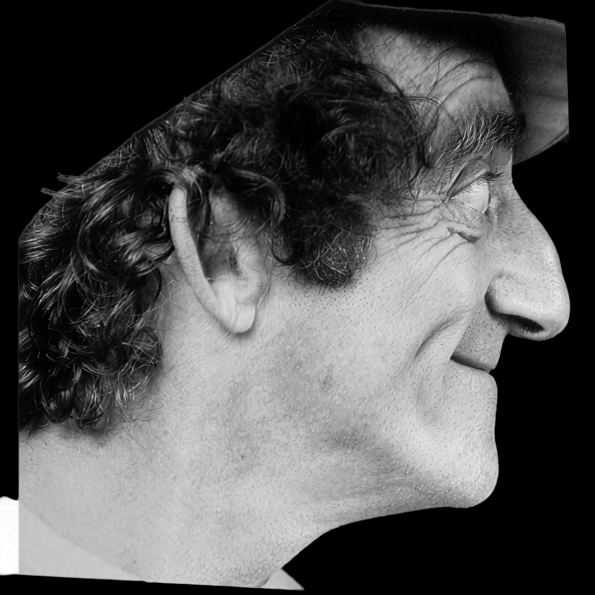 Marty Feldman, Nasofrontal Angle