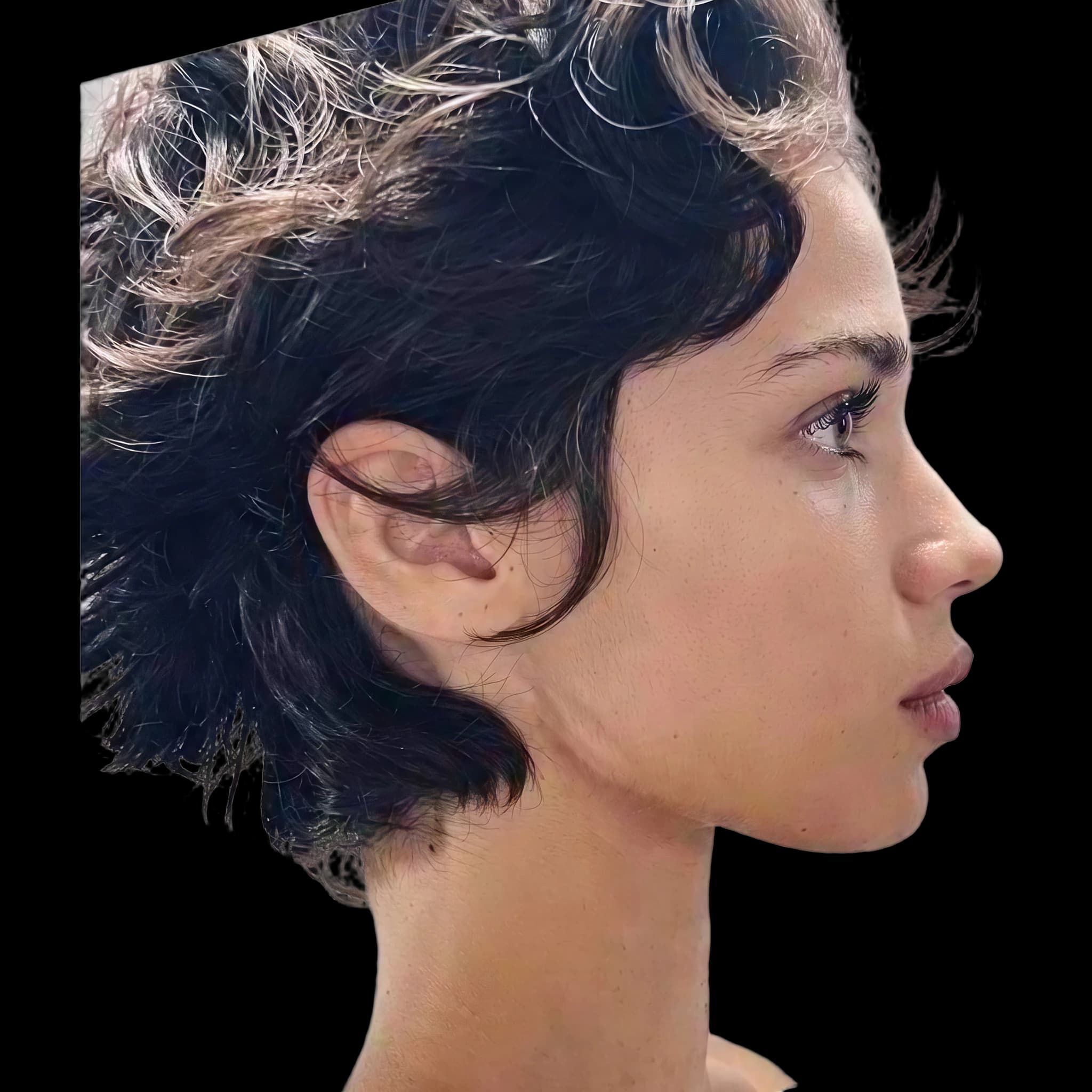 Mathilda Gvarliani, Upper Lip E-Line Position