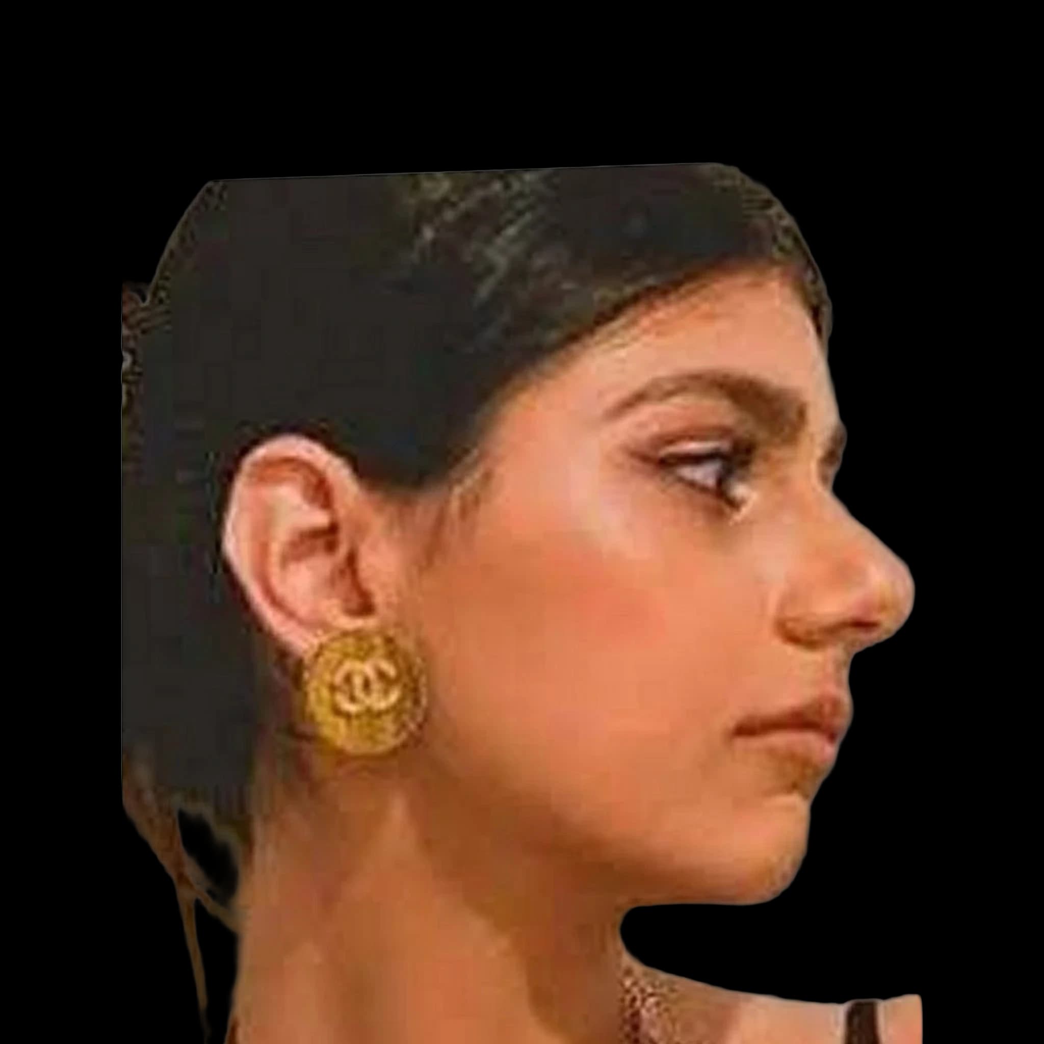Mia Khalifa, Submental Definition