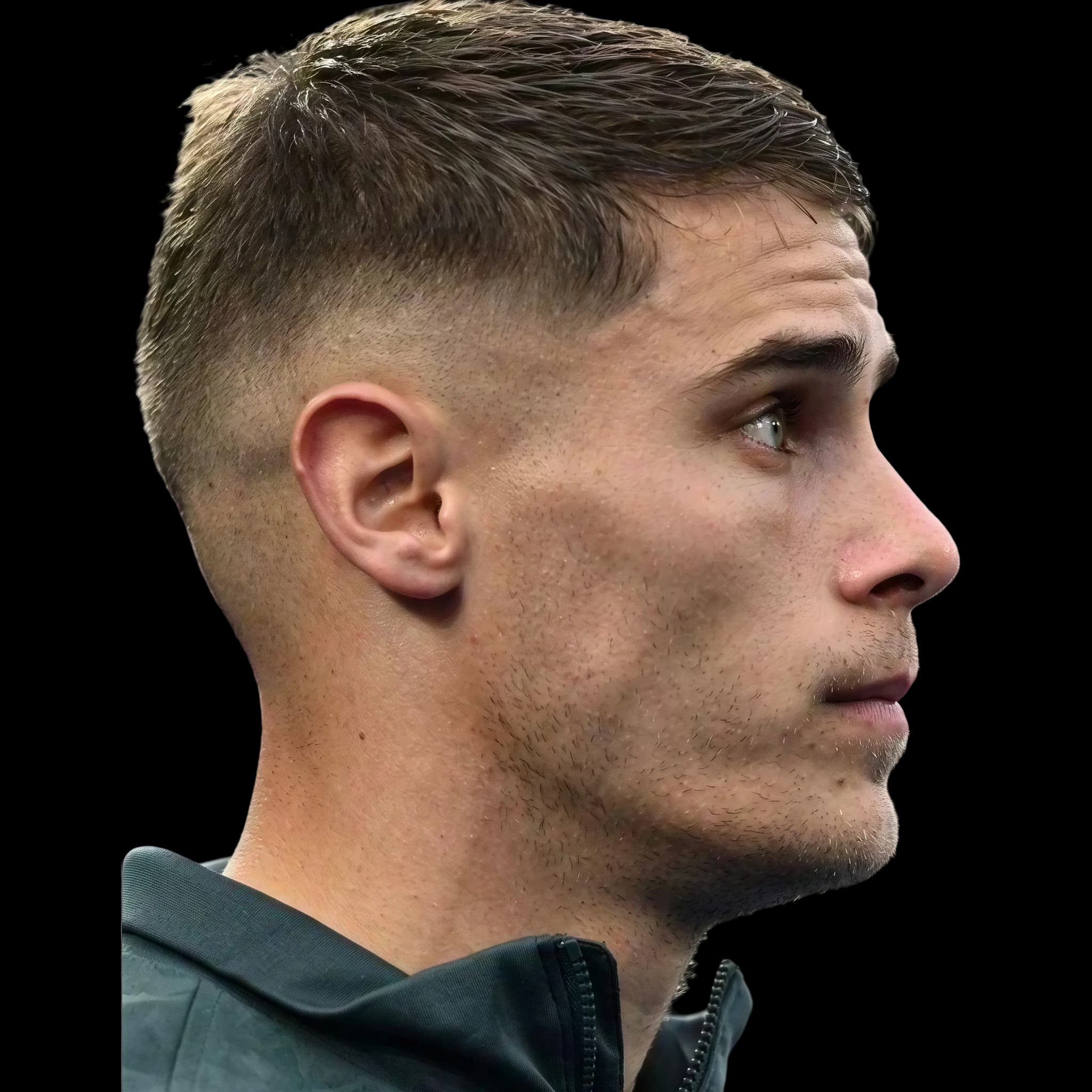 Micky van de Ven, Eye Protrusion