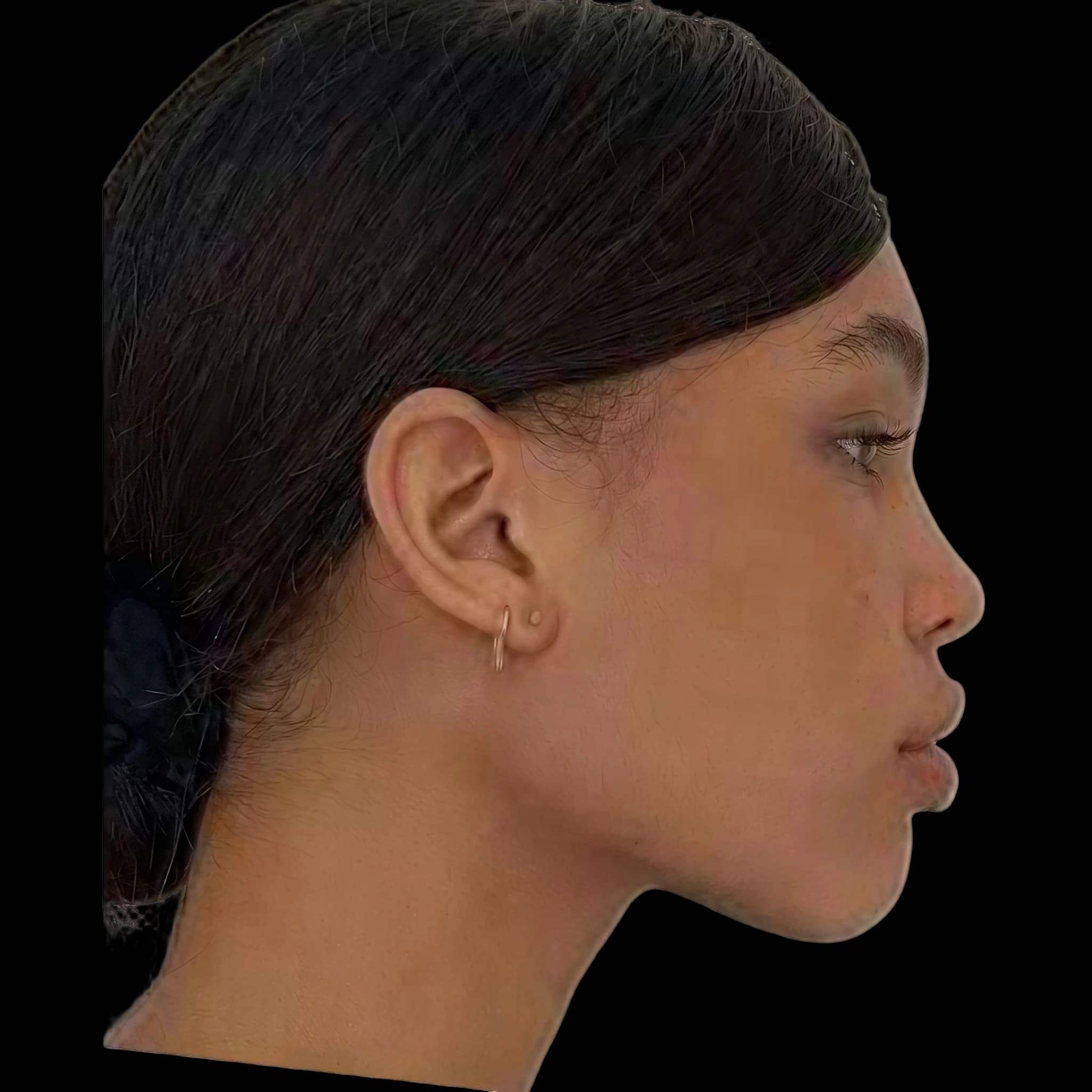 Nara Smith, Upper Lip E-Line Position