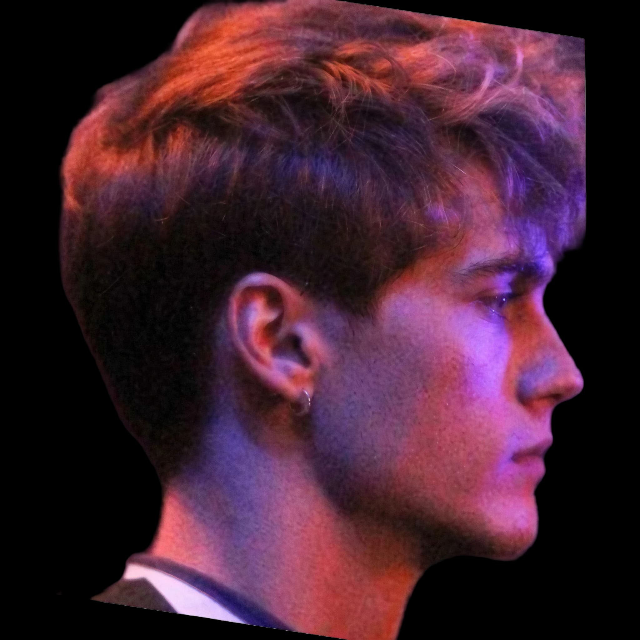 Neels Visser, Nasolabial Angle