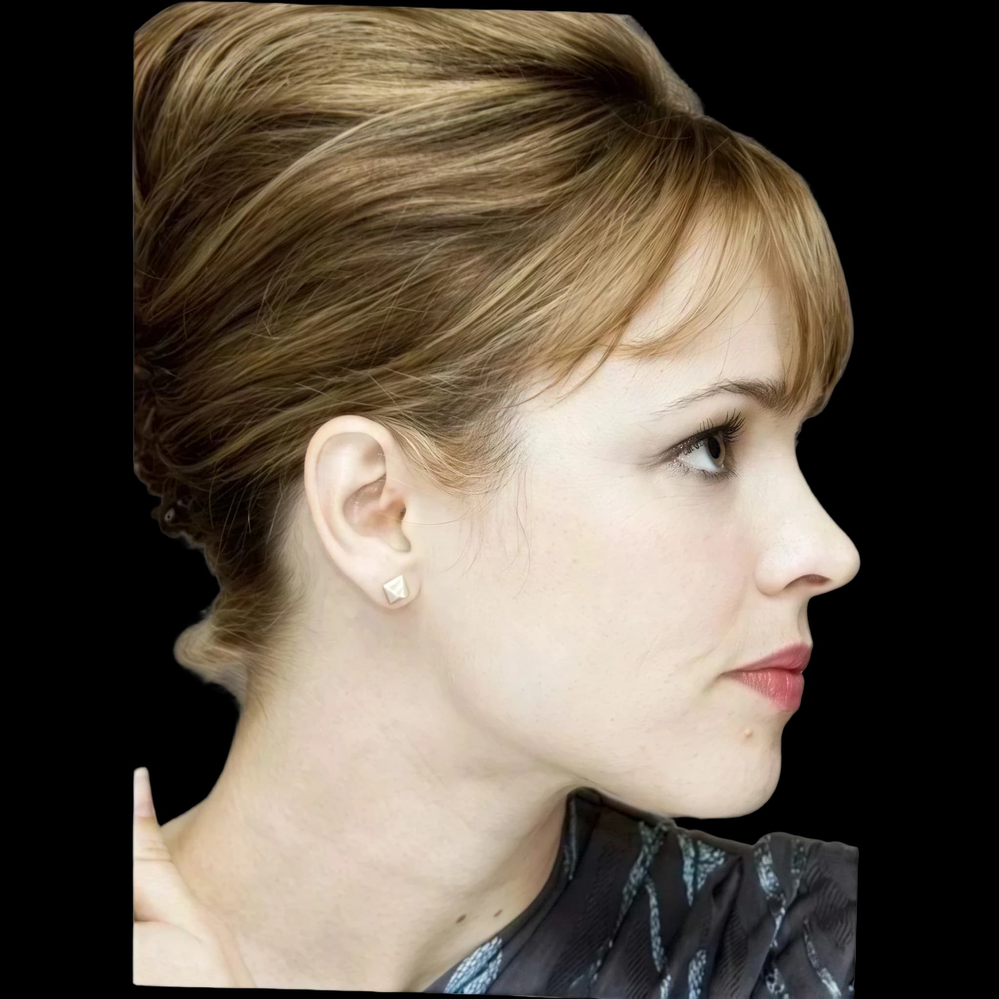 Rachel McAdams, Interior Midface Projection Angle