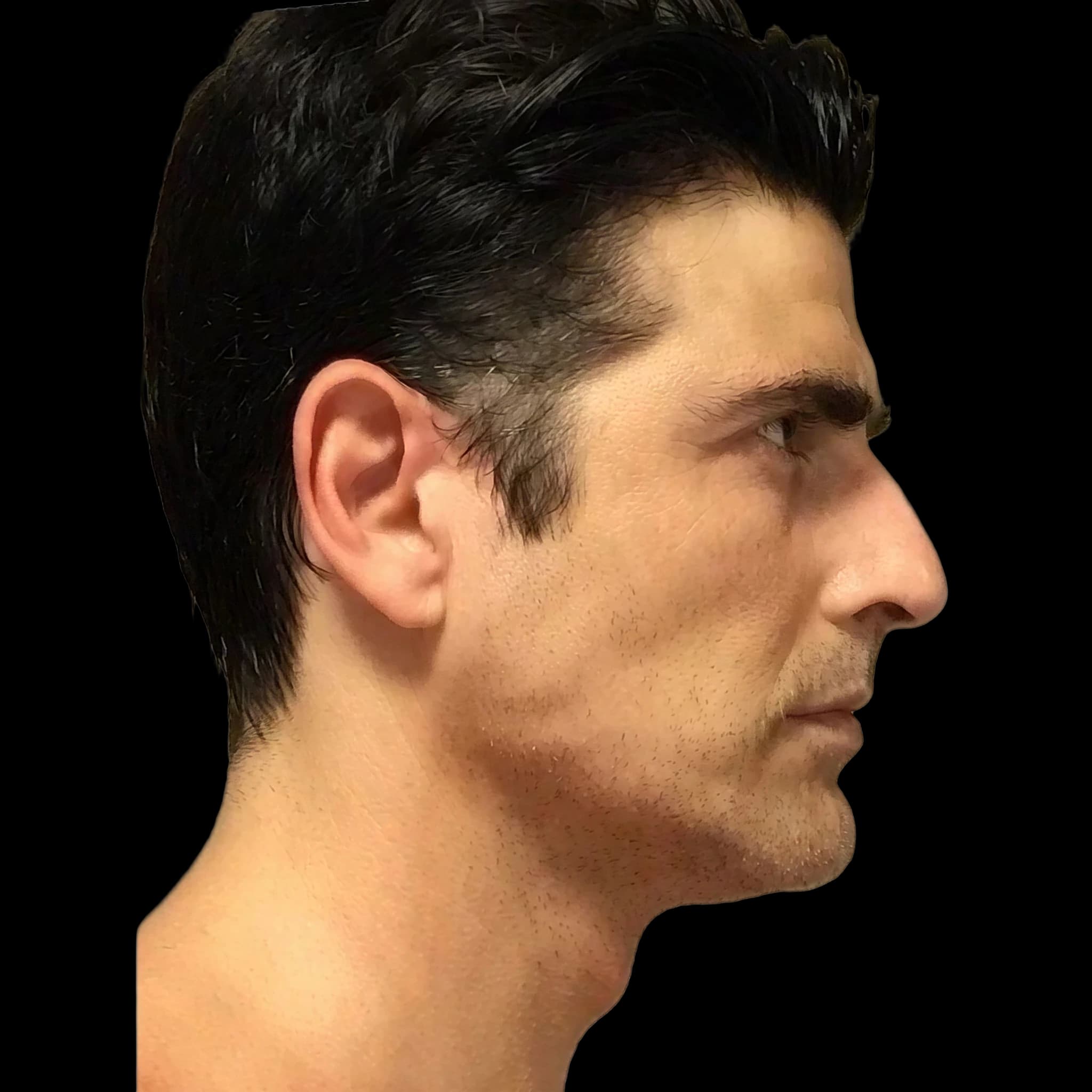 Reynaldo Gianecchini, Gonial Angle