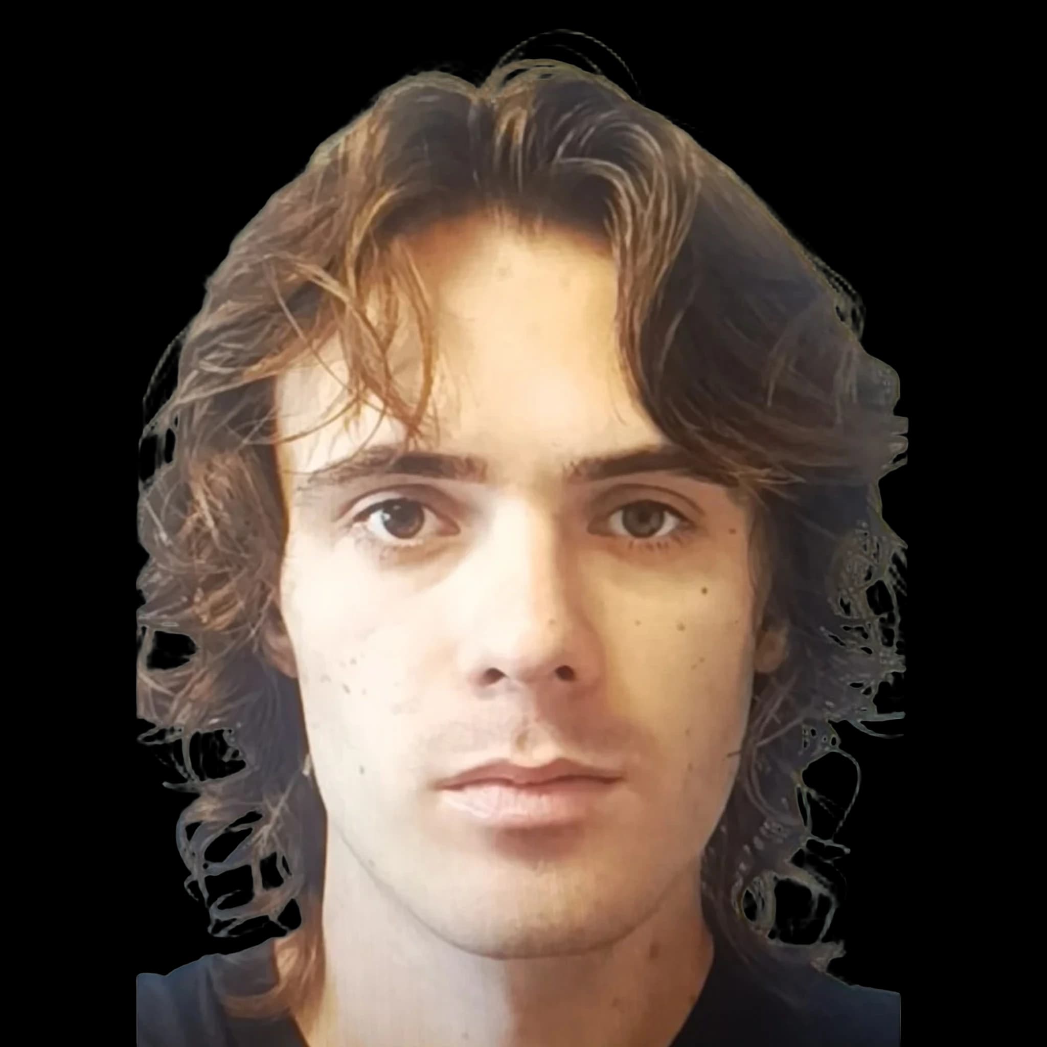 Rubenmaxxing(LooksMaxxer Influencer), Hyperpigmentation