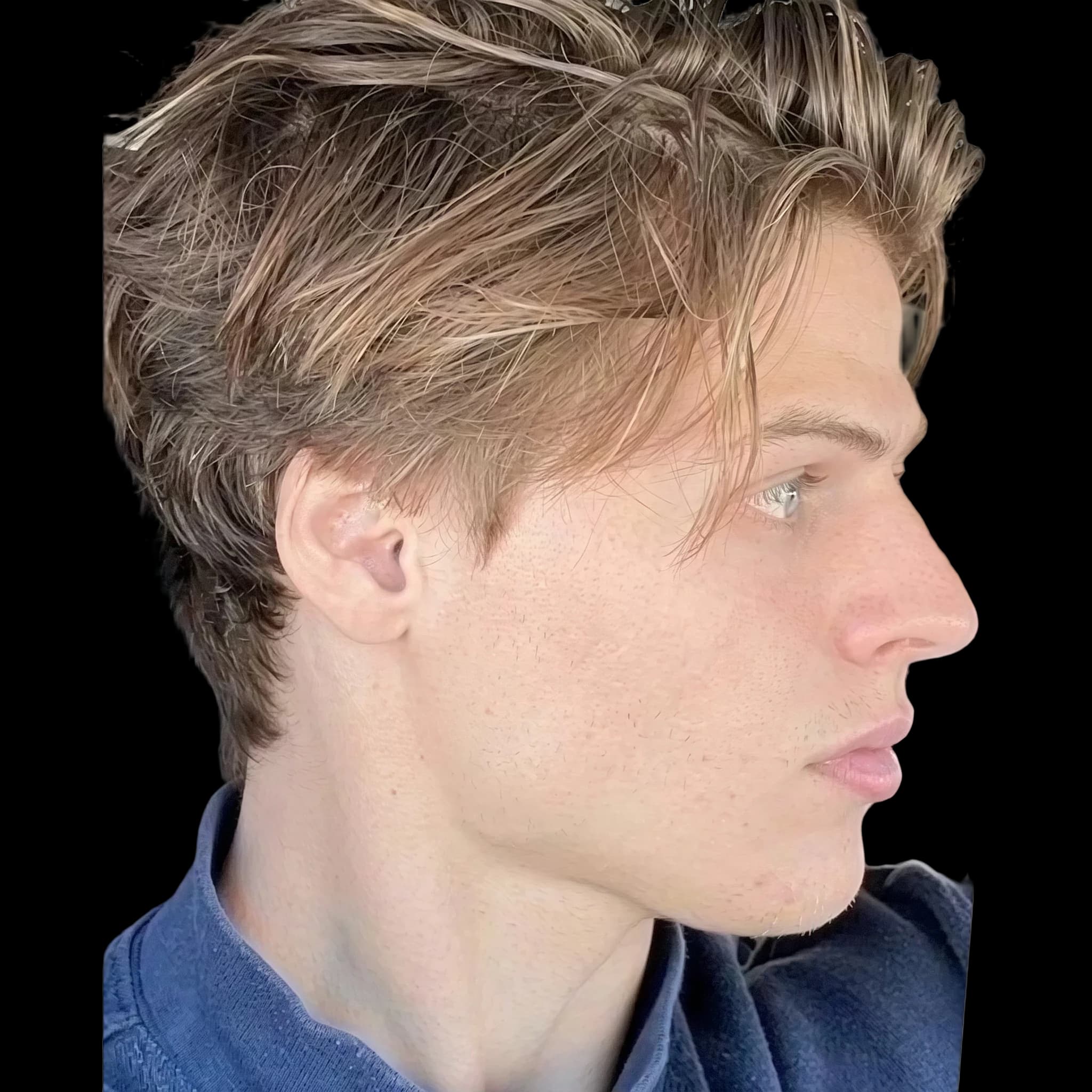 Sam Dezz, Submental Cervical Angle