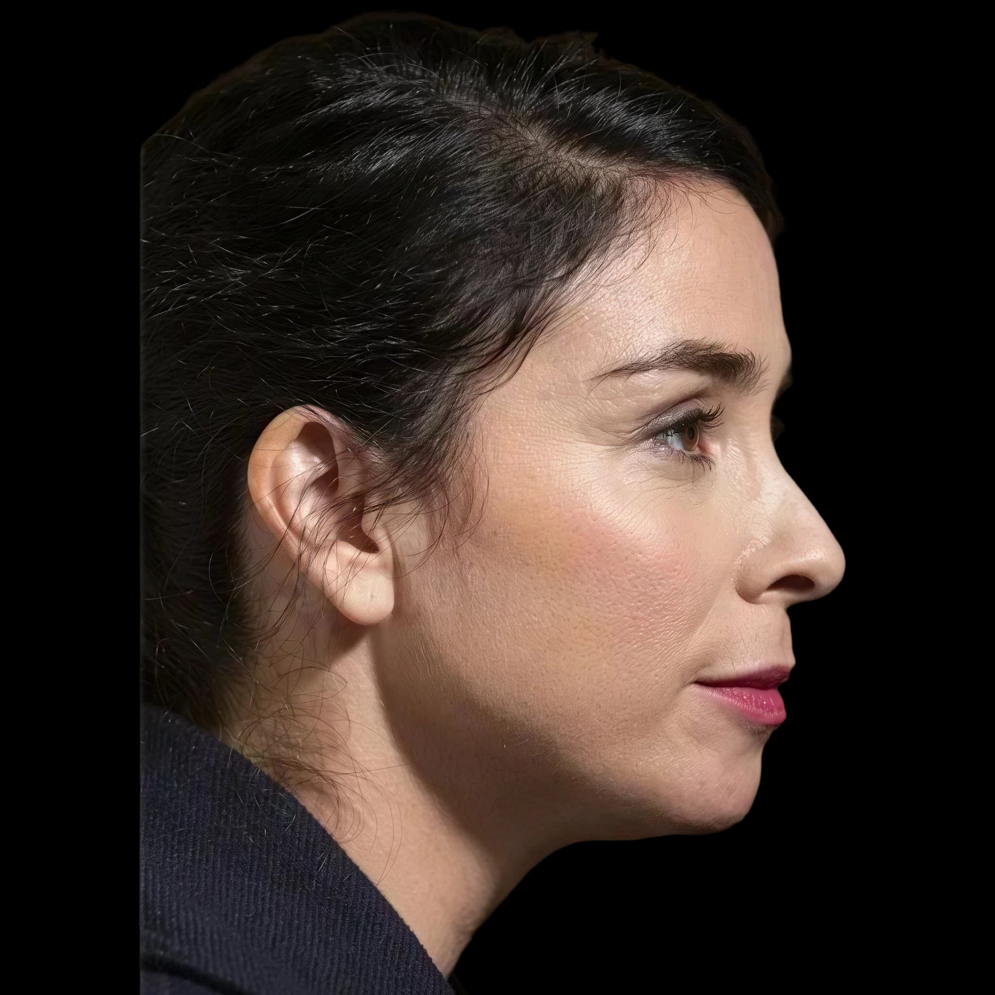 Sarah Silverman, Upper Forehead Slope