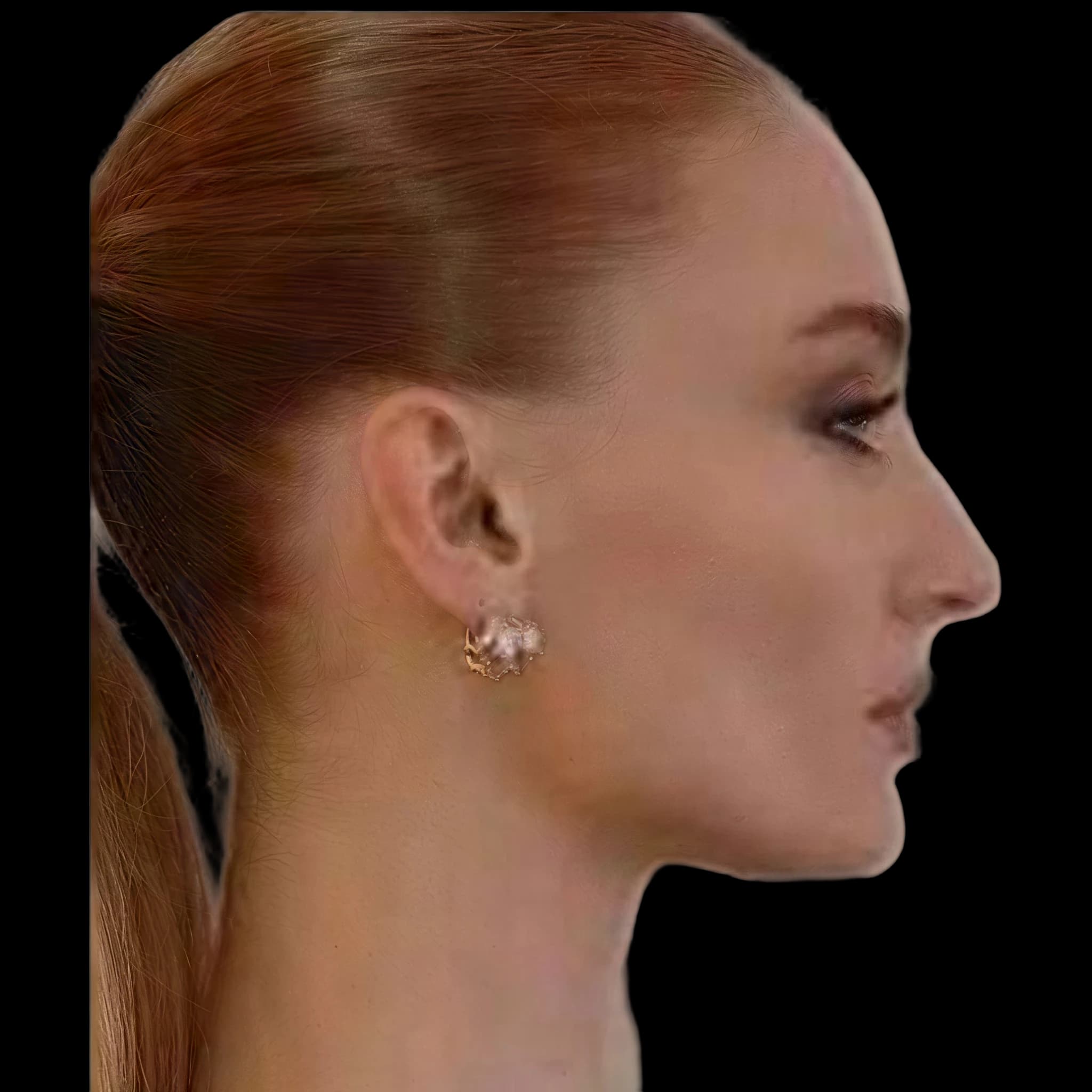 Sophie Turner, Interior Midface Projection Angle