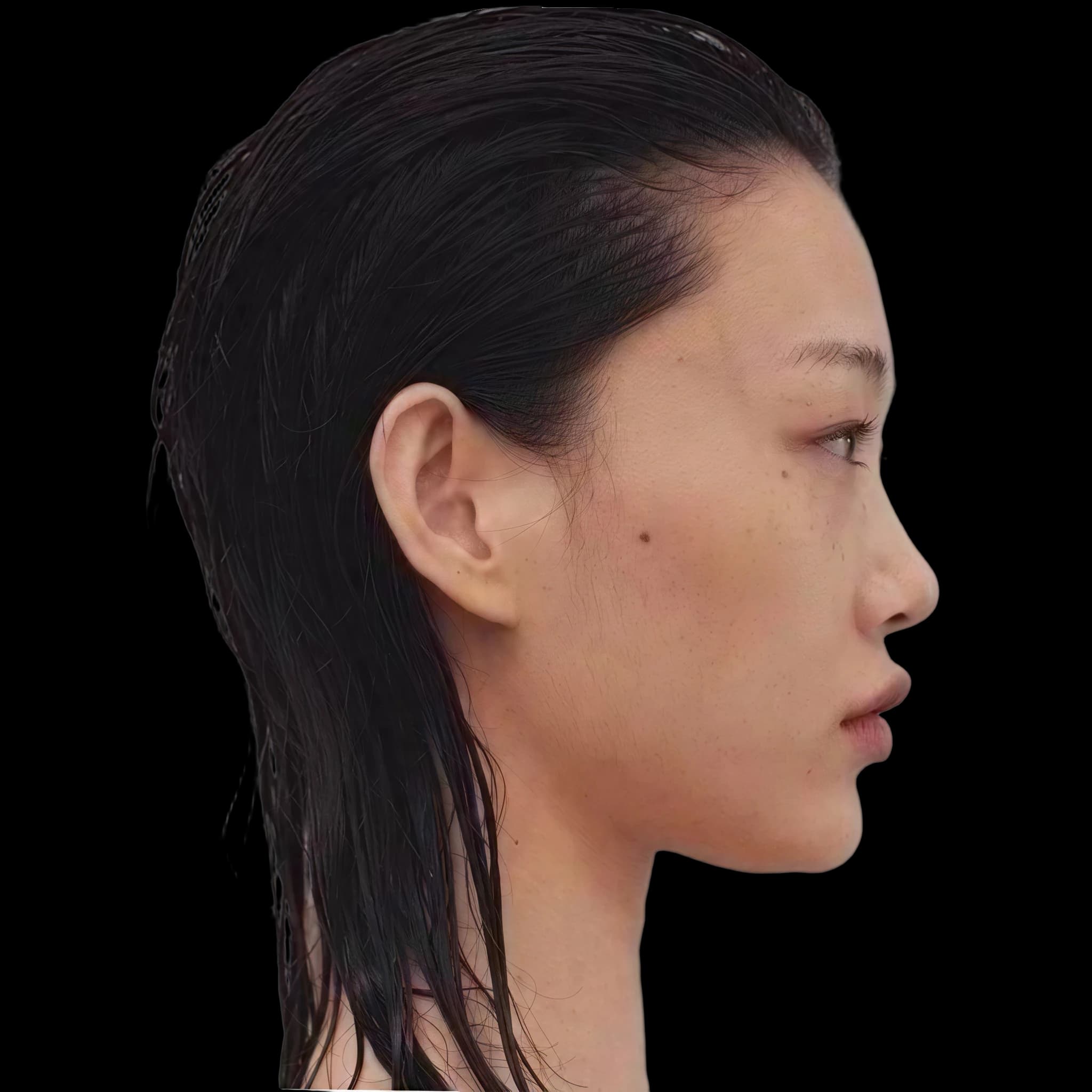 Sora Choi, Lower Lip E-Line Position