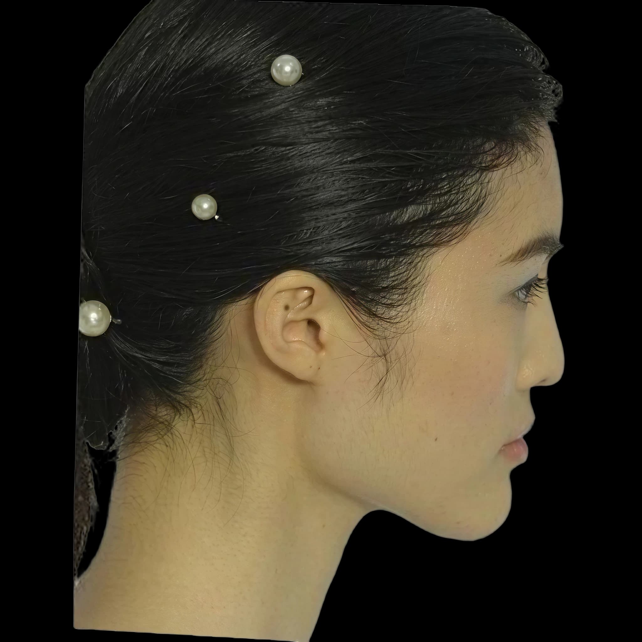 Sui He, Submental Cervical Angle