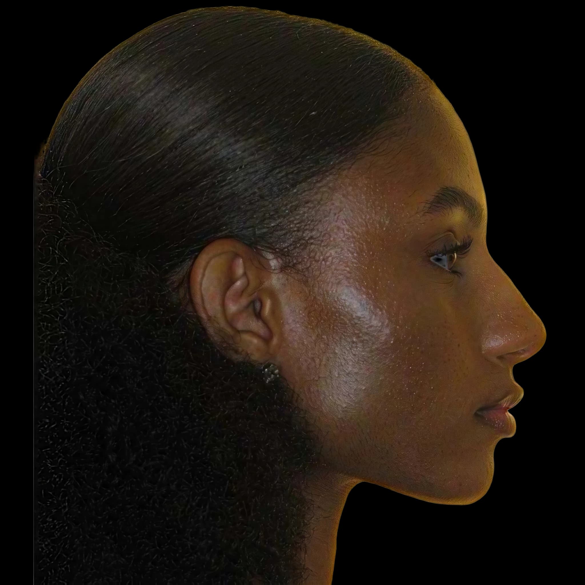 Sydney Harper, Nasofrontal Angle