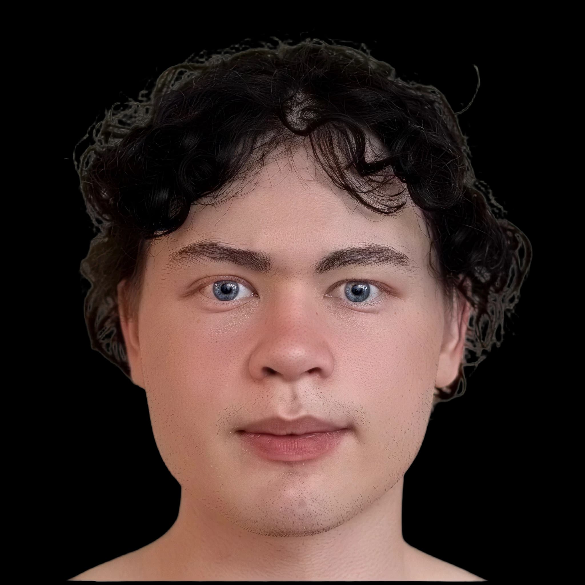 Timothy Haireth (Post Op), Chin Definition
