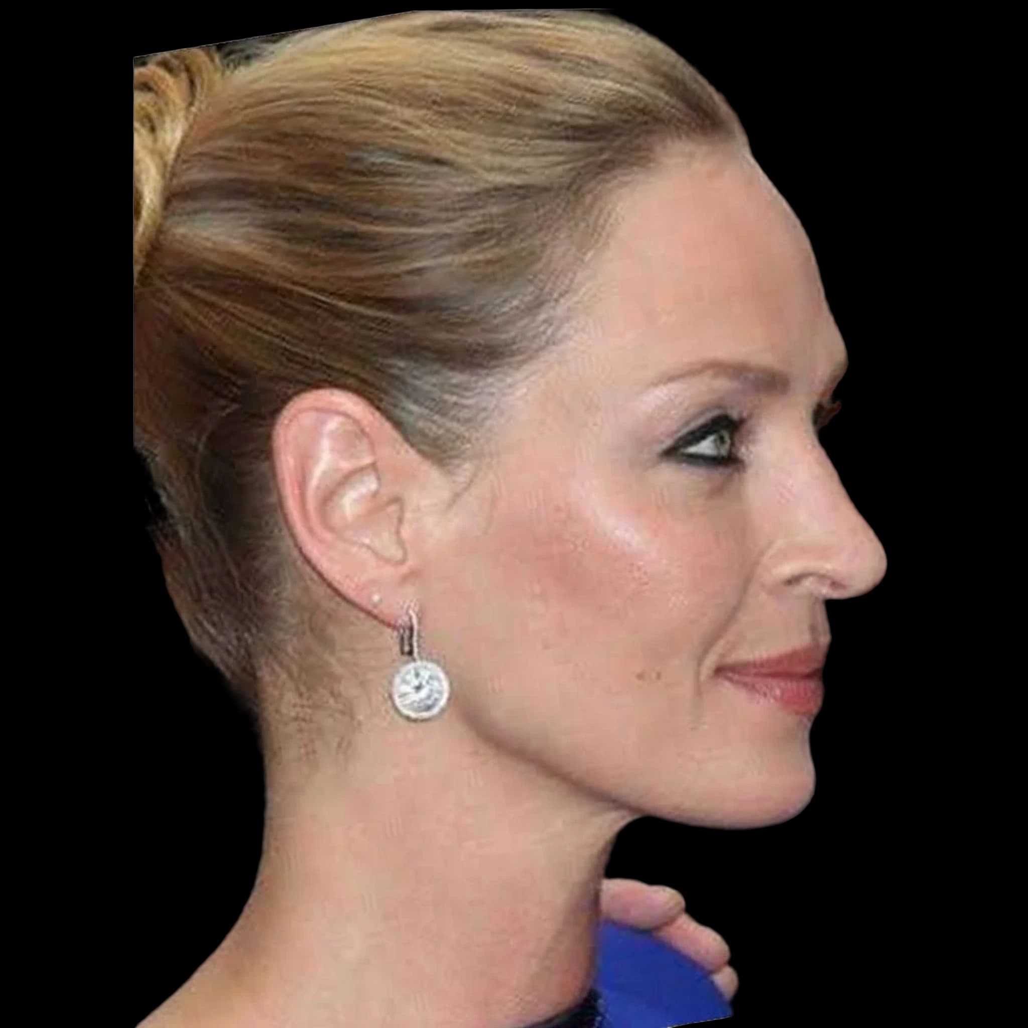 Uma Thurman, Submental Definition