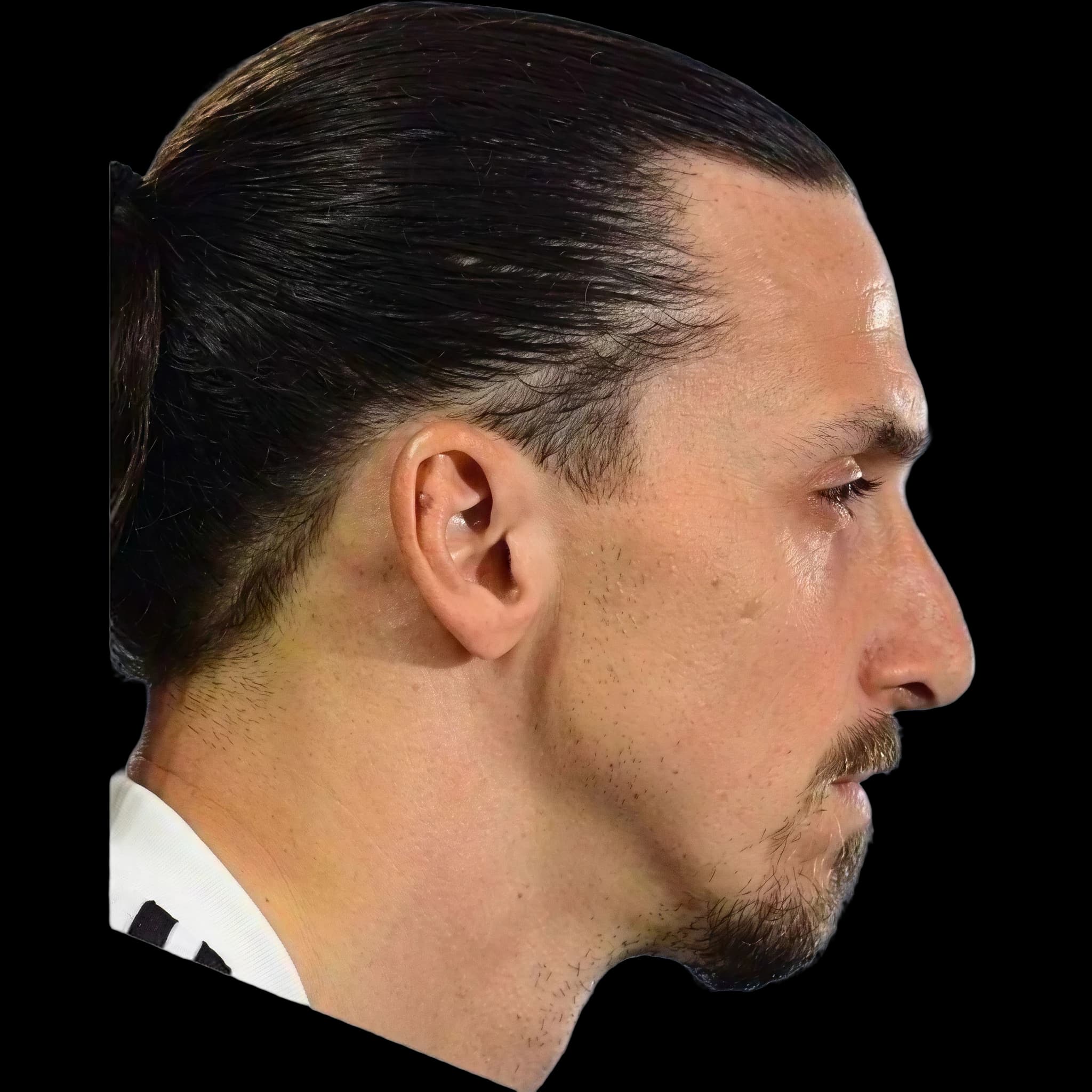 Zlatan Ibrahimović, Nasolabial Angle