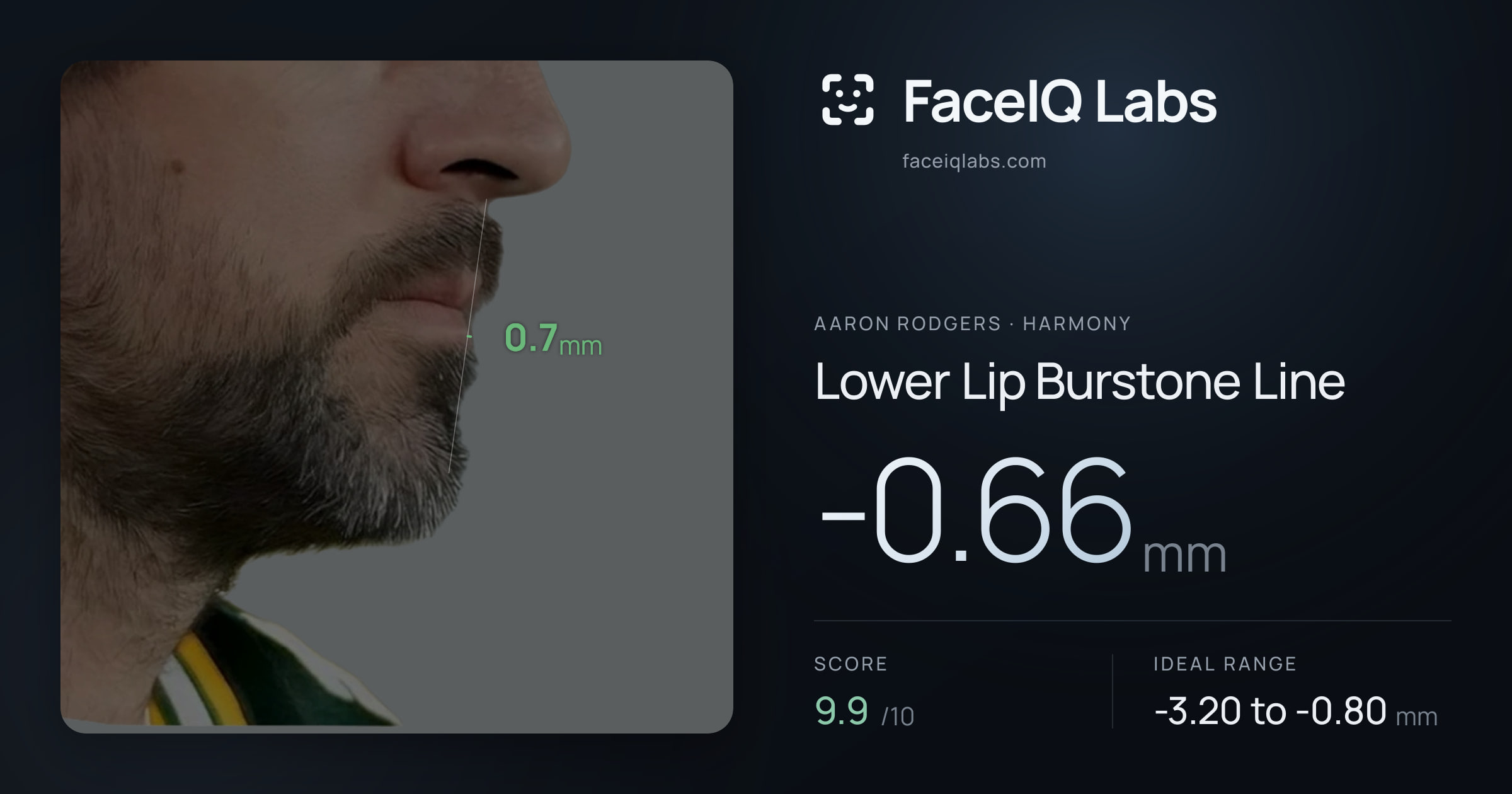 Aaron Rodgers Lower Lip Burstone Line: -0.66mm, drawn on the photo