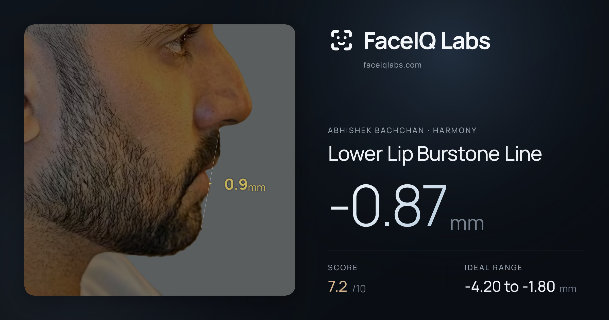 Abhishek Bachchan Lower Lip Burstone Line: -0.87mm, drawn on the photo