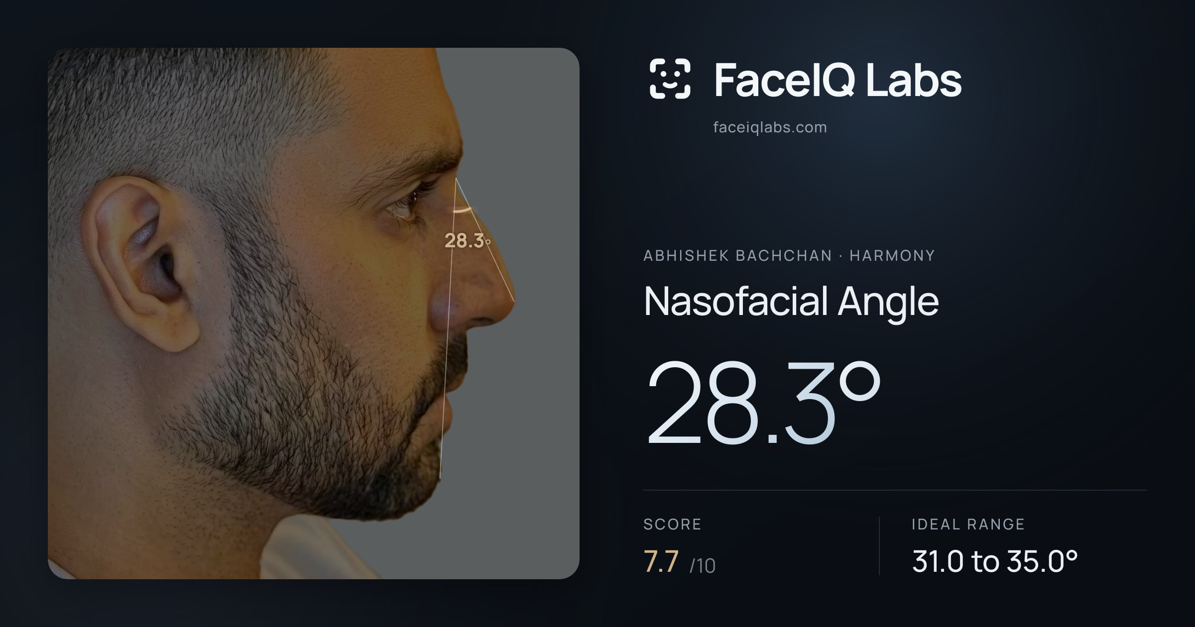 Abhishek Bachchan Nasofacial Angle: 28.3°, drawn on the photo