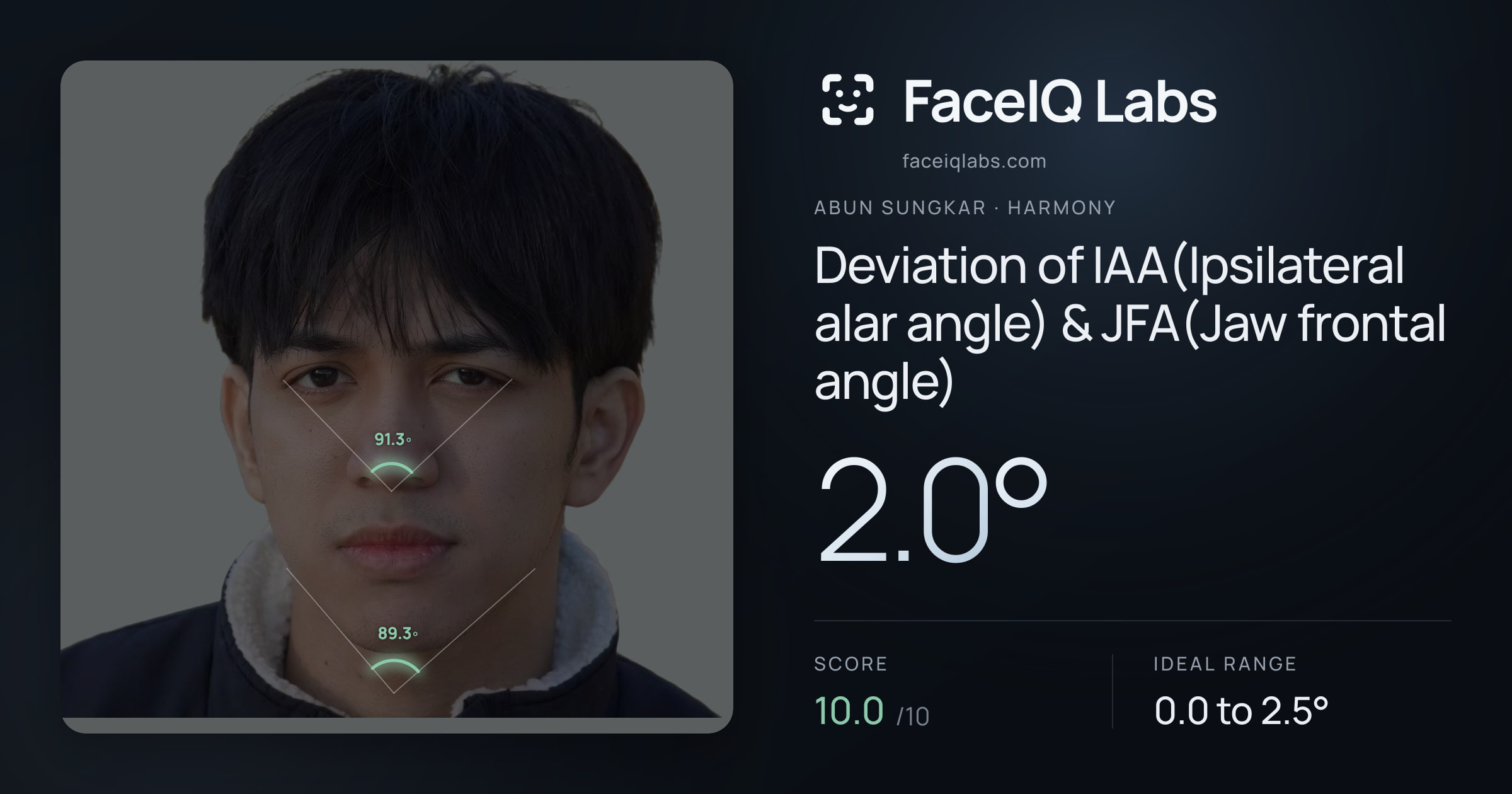 Abun Sungkar Deviation of IAA(Ipsilateral alar angle) & JFA(Jaw frontal angle): 2.0°, drawn on the photo