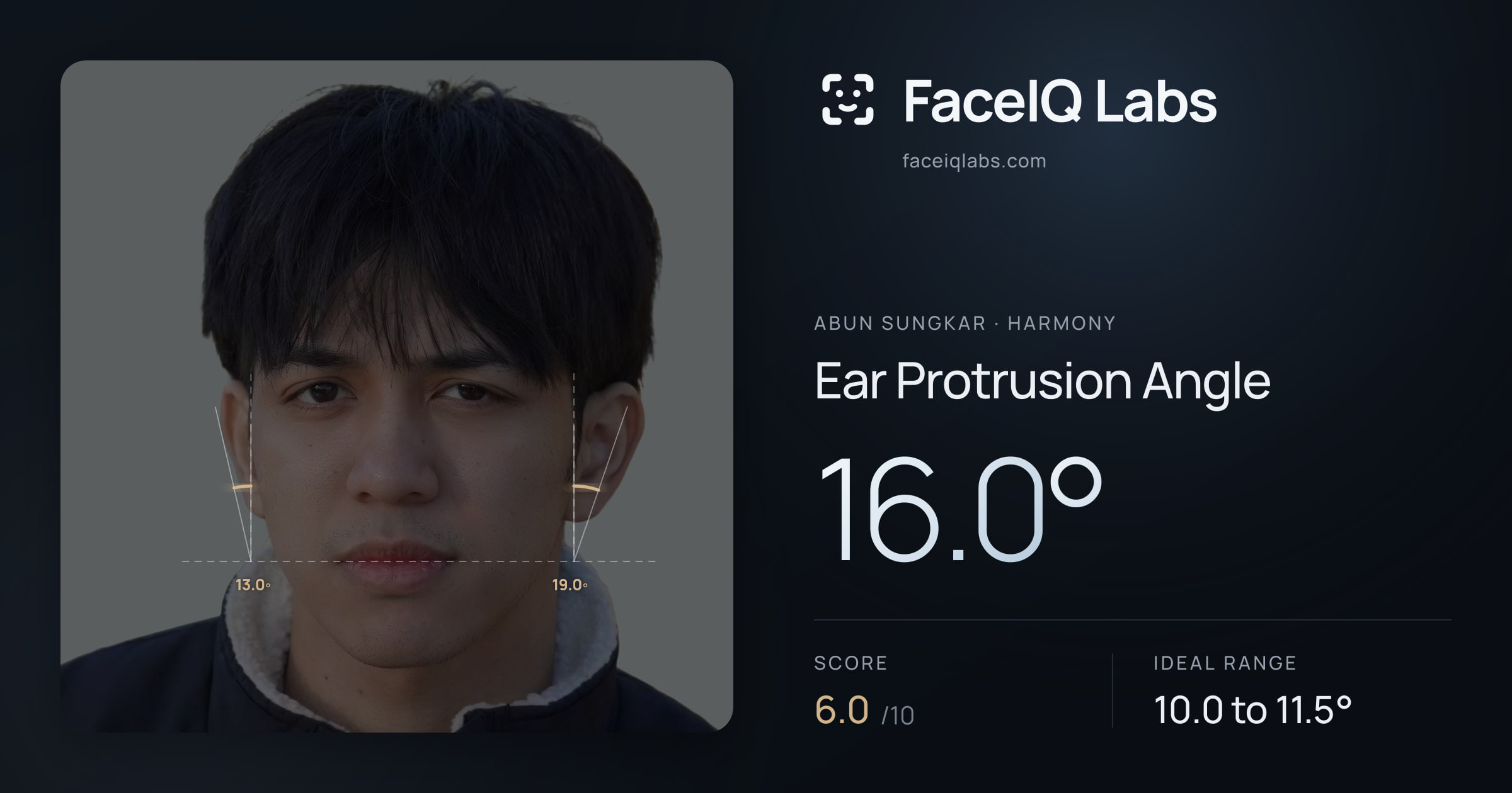 Abun Sungkar Ear Protrusion Angle: 16.0°, drawn on the photo