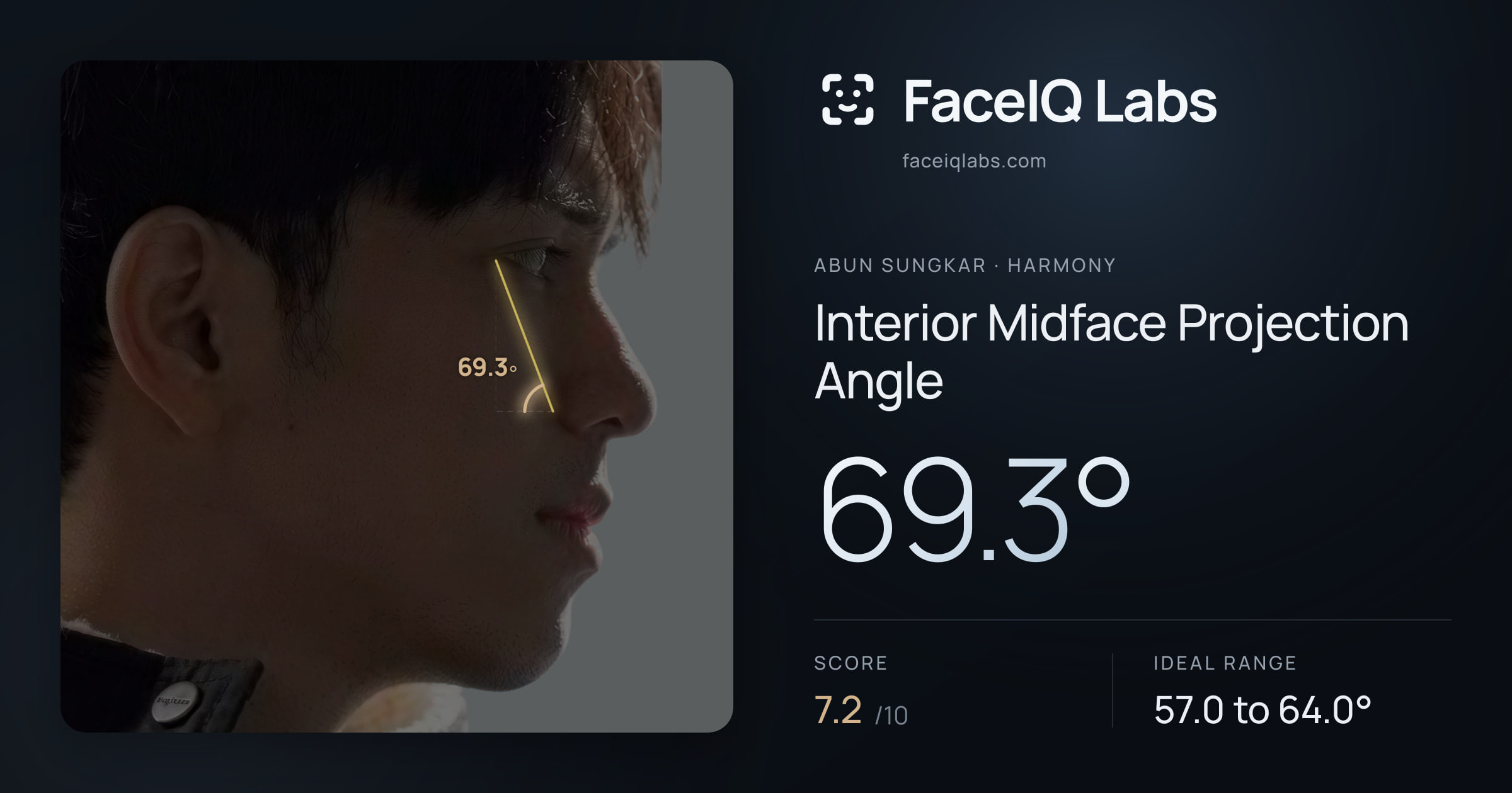 Abun Sungkar Interior Midface Projection Angle: 69.3°, drawn on the photo
