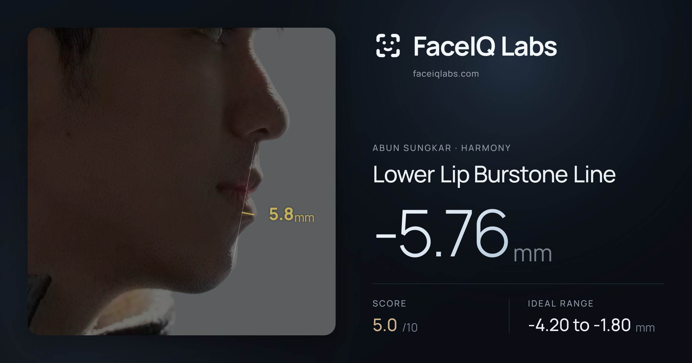 Abun Sungkar Lower Lip Burstone Line: -5.76mm, drawn on the photo