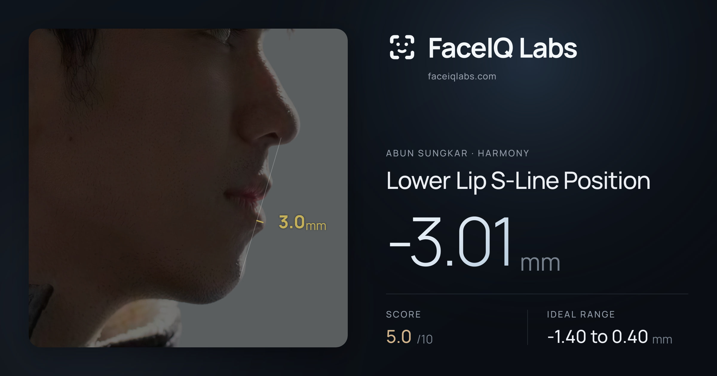 Abun Sungkar Lower Lip S-Line Position: -3.01mm, drawn on the photo