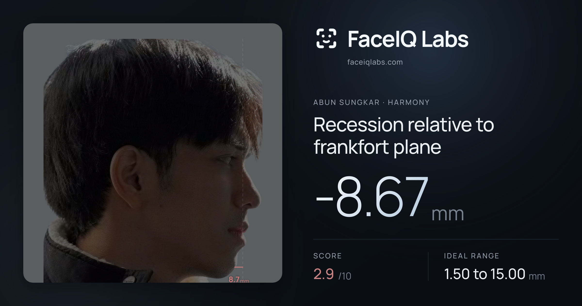 Abun Sungkar Recession relative to frankfort plane: -8.67mm, drawn on the photo