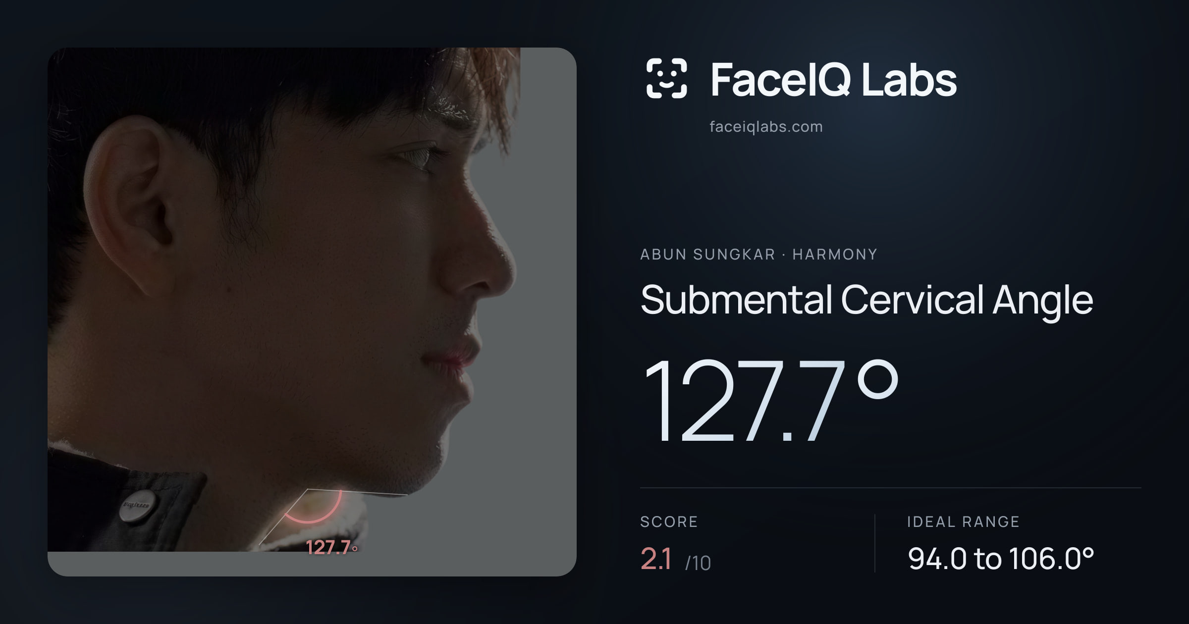 Abun Sungkar Submental Cervical Angle: 127.7°, drawn on the photo