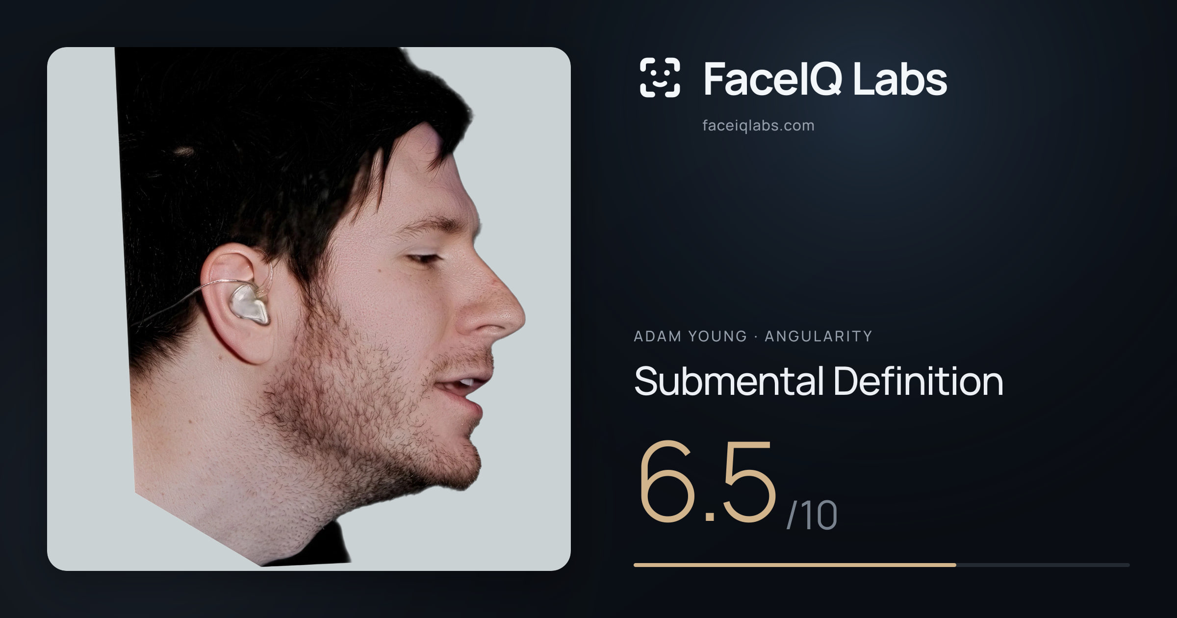 Adam Young Submental Definition: 6.5/10, drawn on the photo