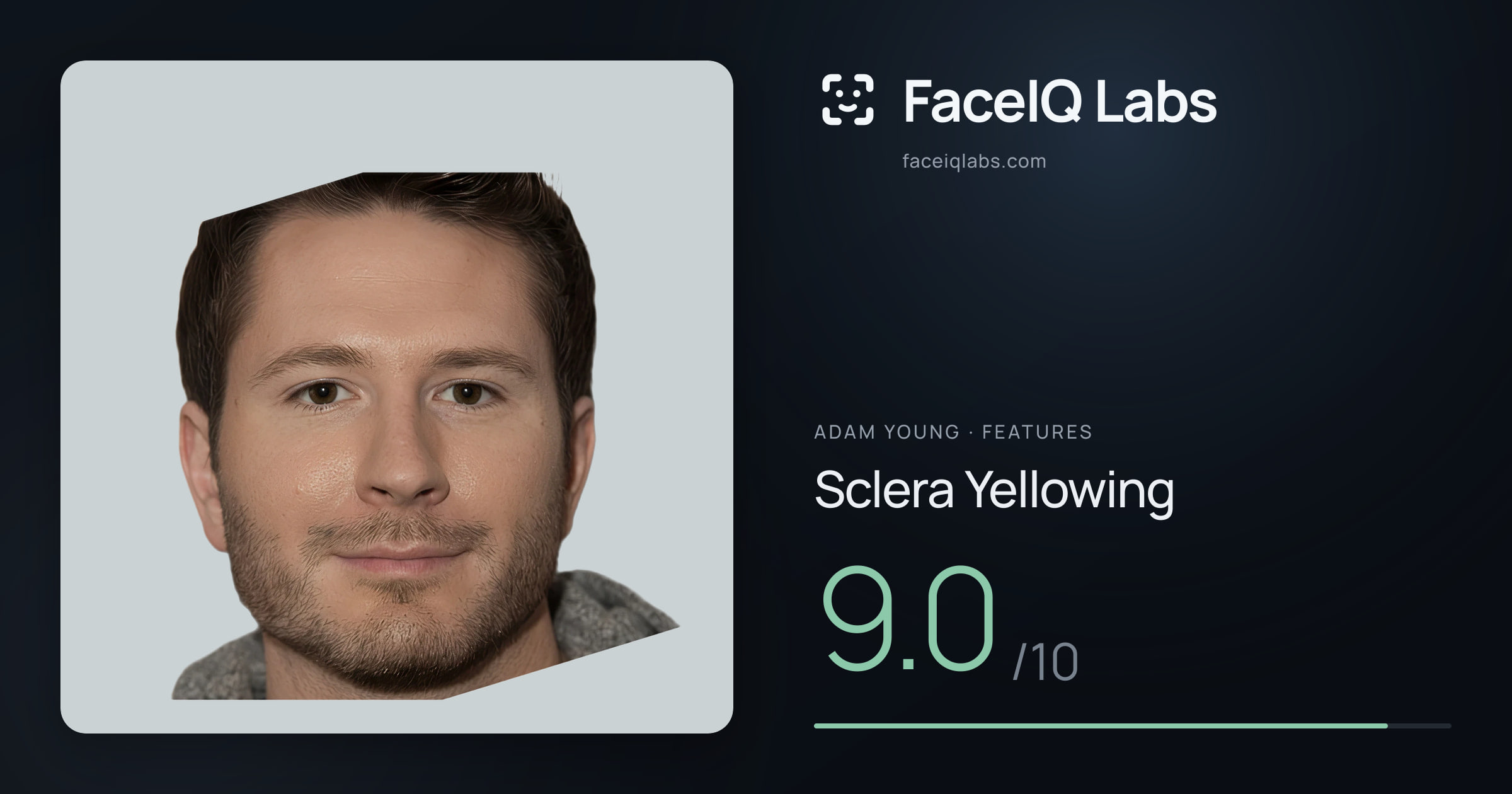 Adam Young Sclera Yellowing: 9.0/10, drawn on the photo